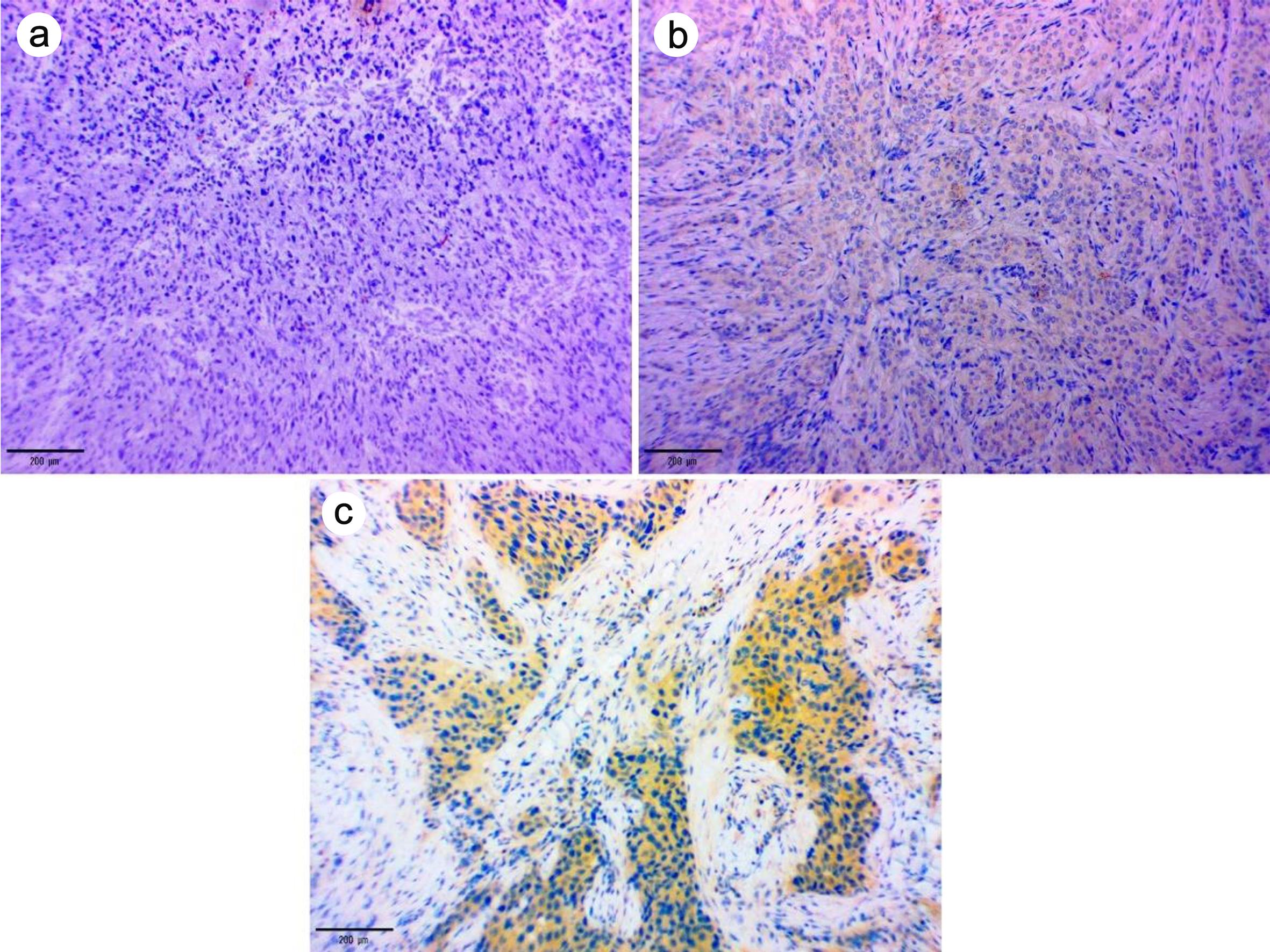 Examples of CXCR4 expression intensity in tumor cells.