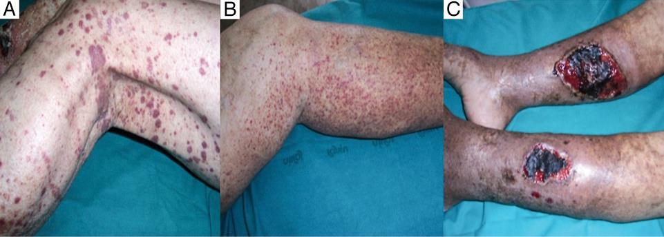 A, Cutaneous palpable purpura; B, Complex confluent purpura; C, Ulcerations of skin due to cryoglobulinemic purpura.