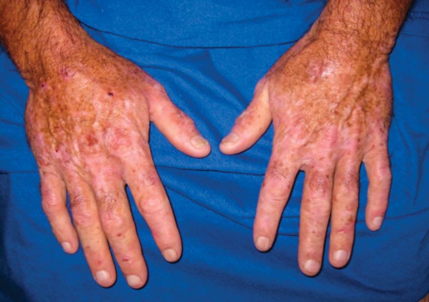Dermatologic blisters and hyperpigmentation findings in porphyria cutanea tarda seen in sun-exposed areas.