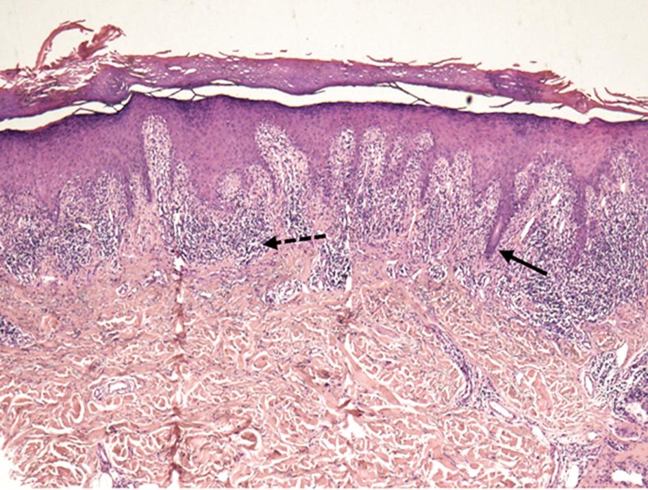 Histopathology of lichen planus.