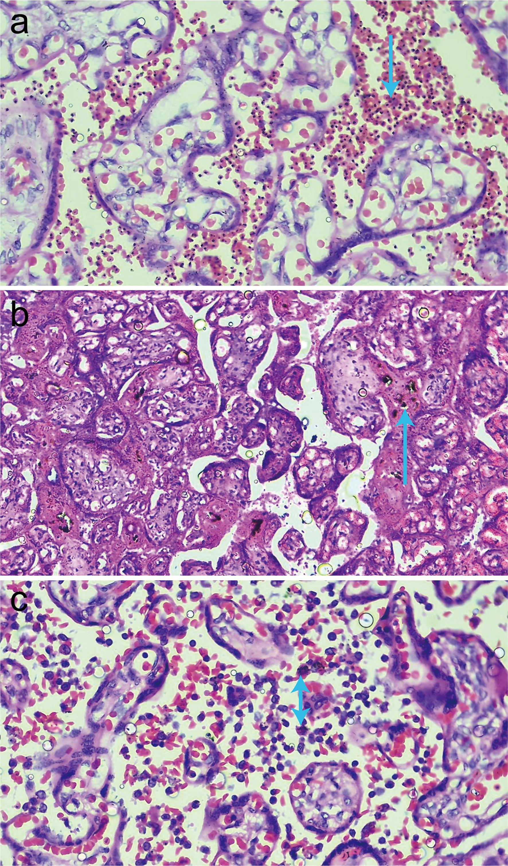 Histological slides showing different types of placental malaria.