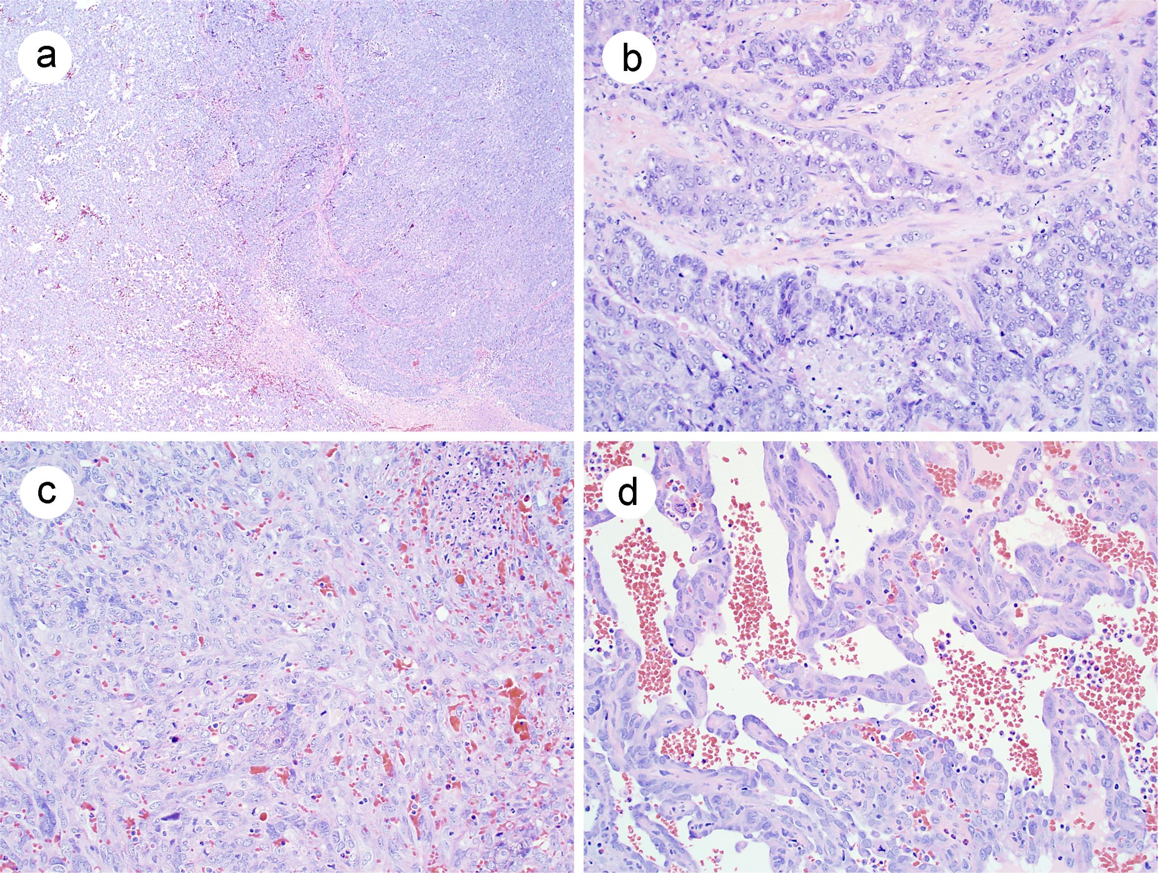 Histological features of MMMT.