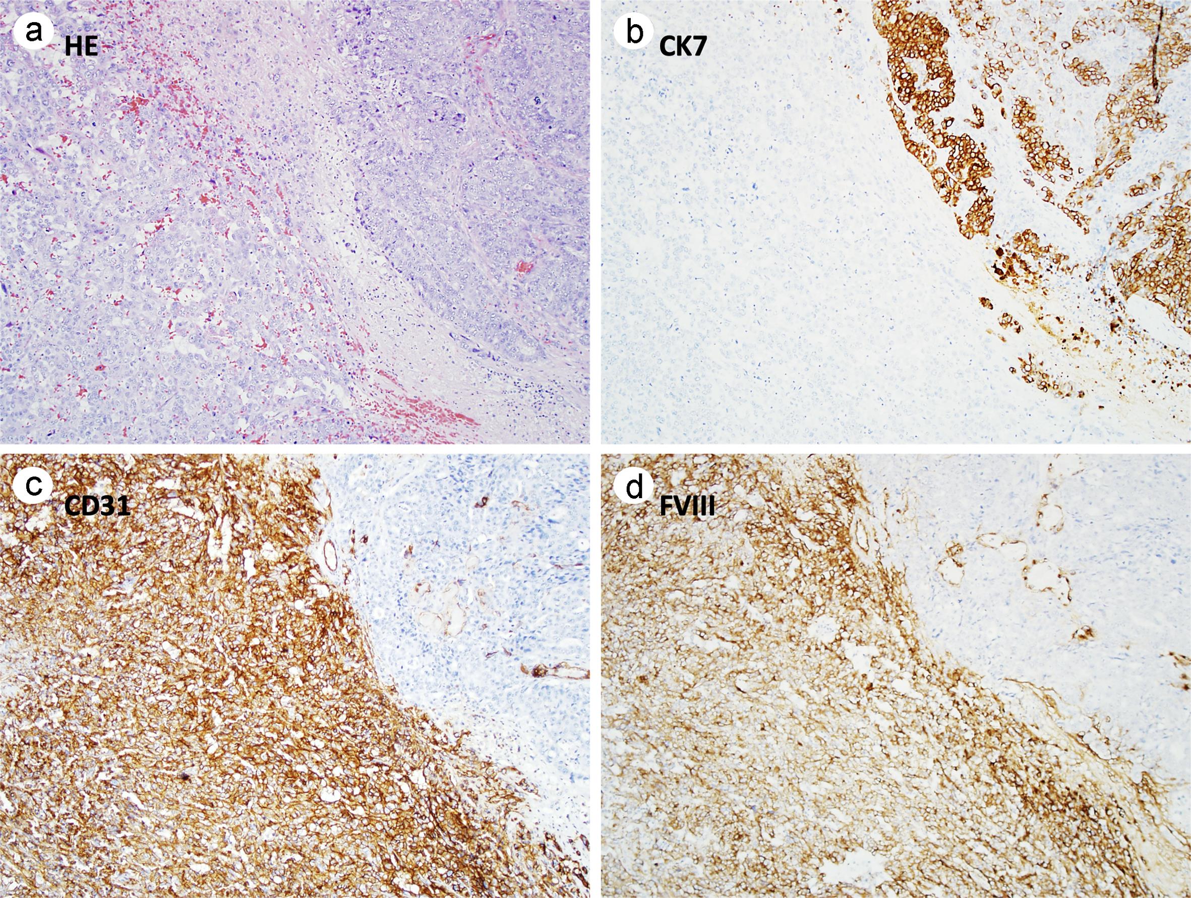 Immunohistochemical profiles of MMMT.
