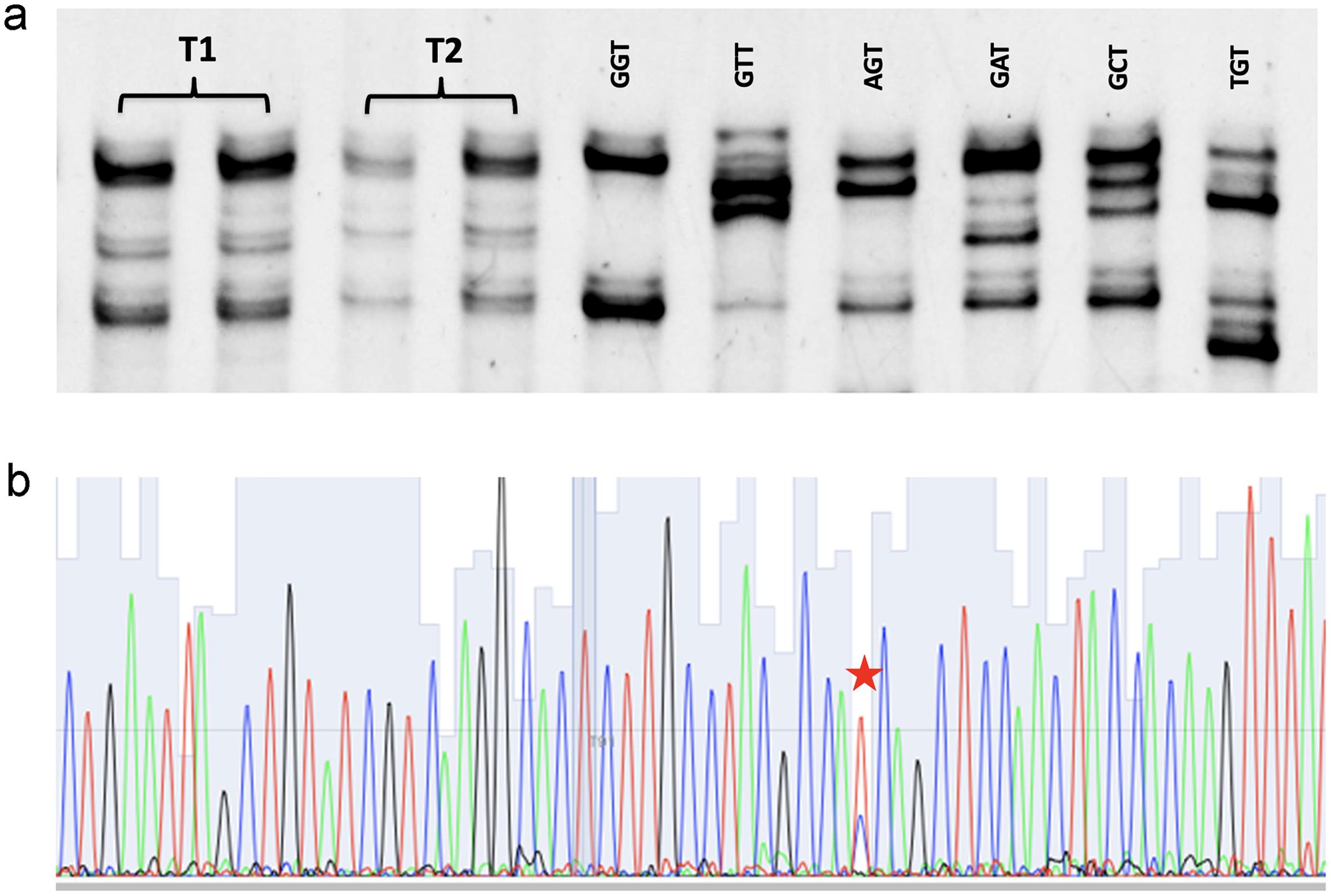 <italic>KRAS</italic> mutation status of serous carcinomatous and angiosarcomatous components of MMMT.