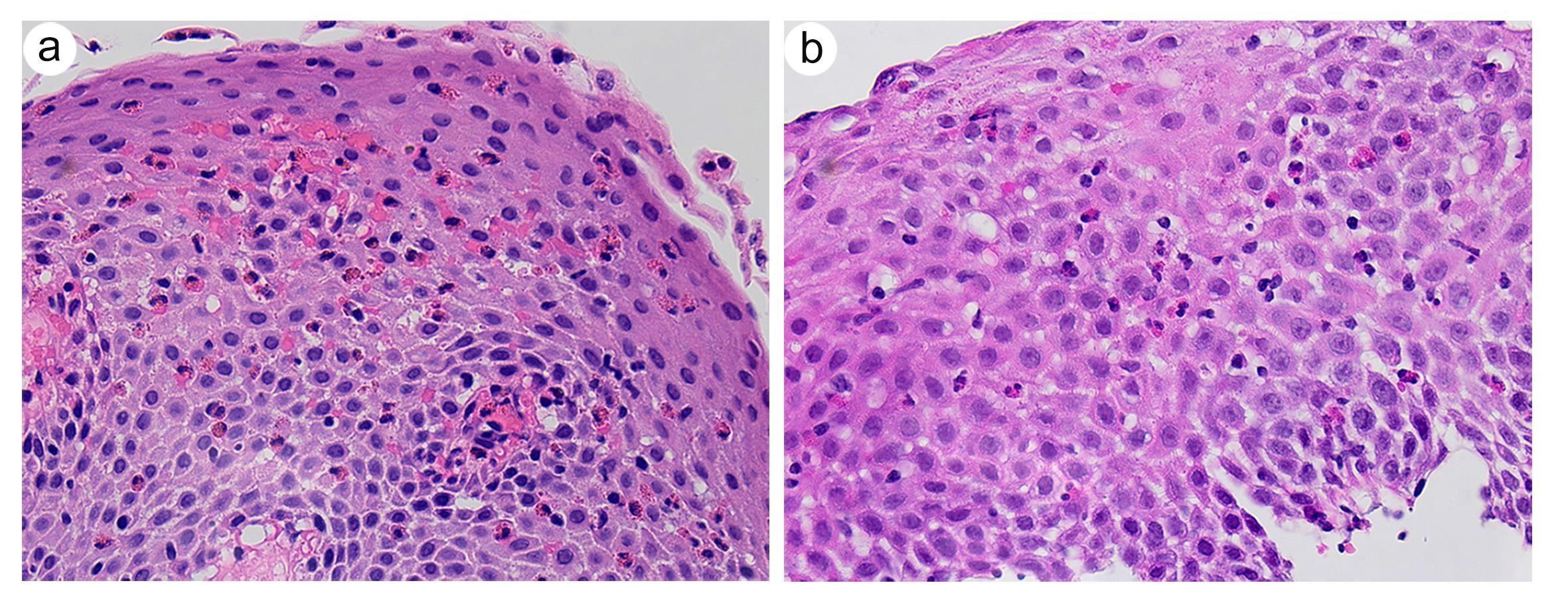 Histologic changes in eosinophilic esophagitis (EoE) with concurrent gastric <italic>Helicobacter</italic><italic>pylori</italic> infection.