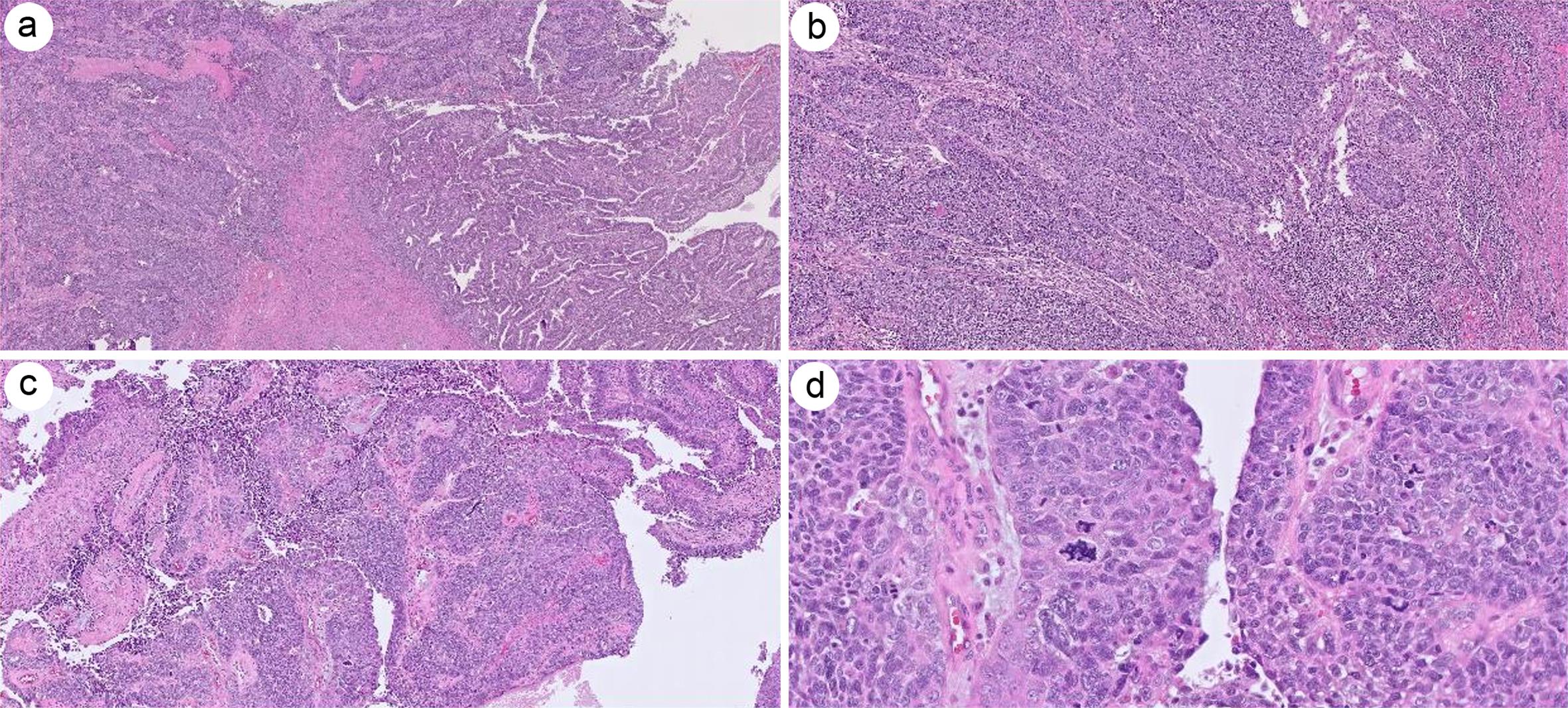 (POLE)-mutated FIGO 3 endometrioid carcinoma.