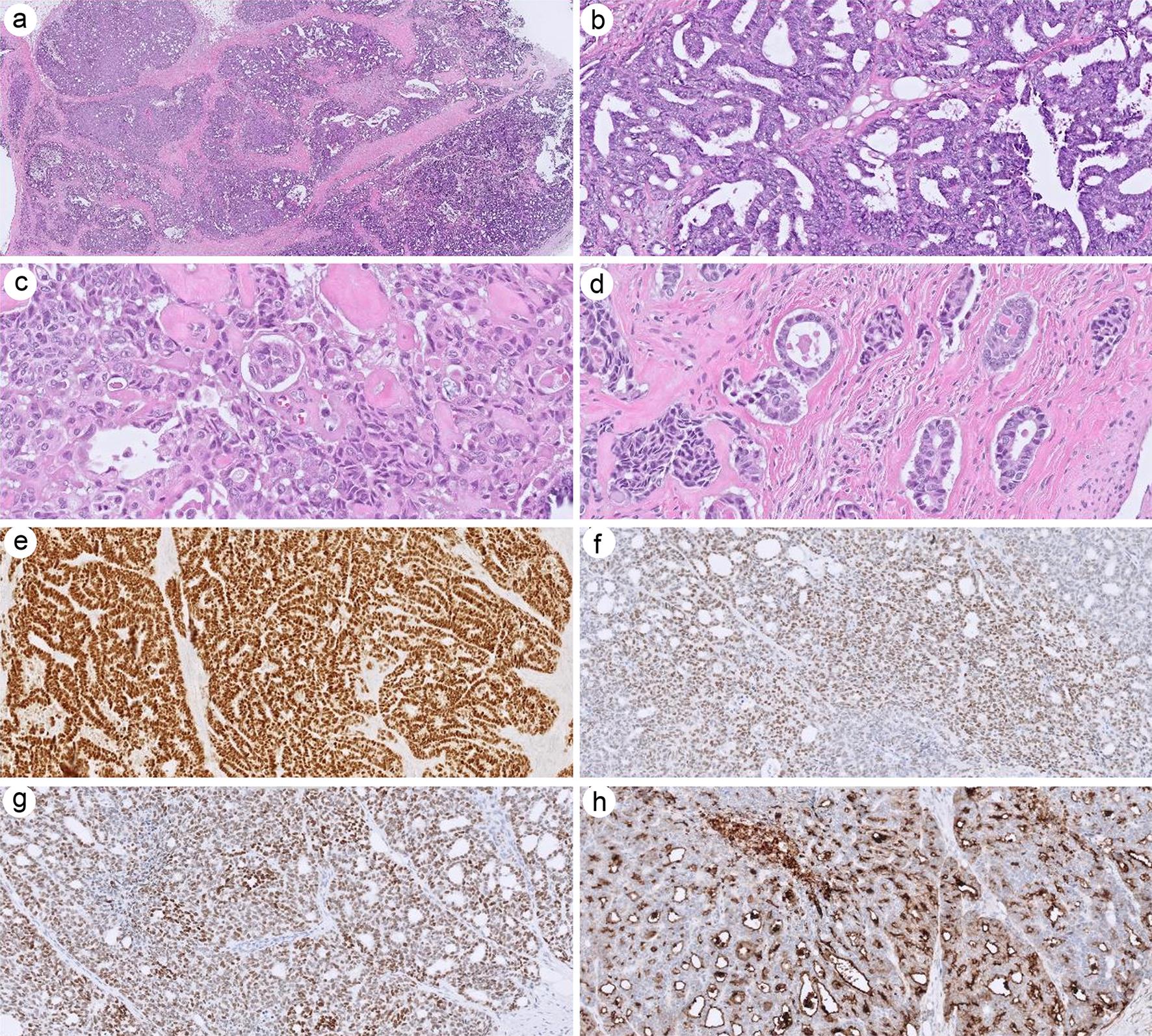 Mesonephric-like adenocarcinoma.