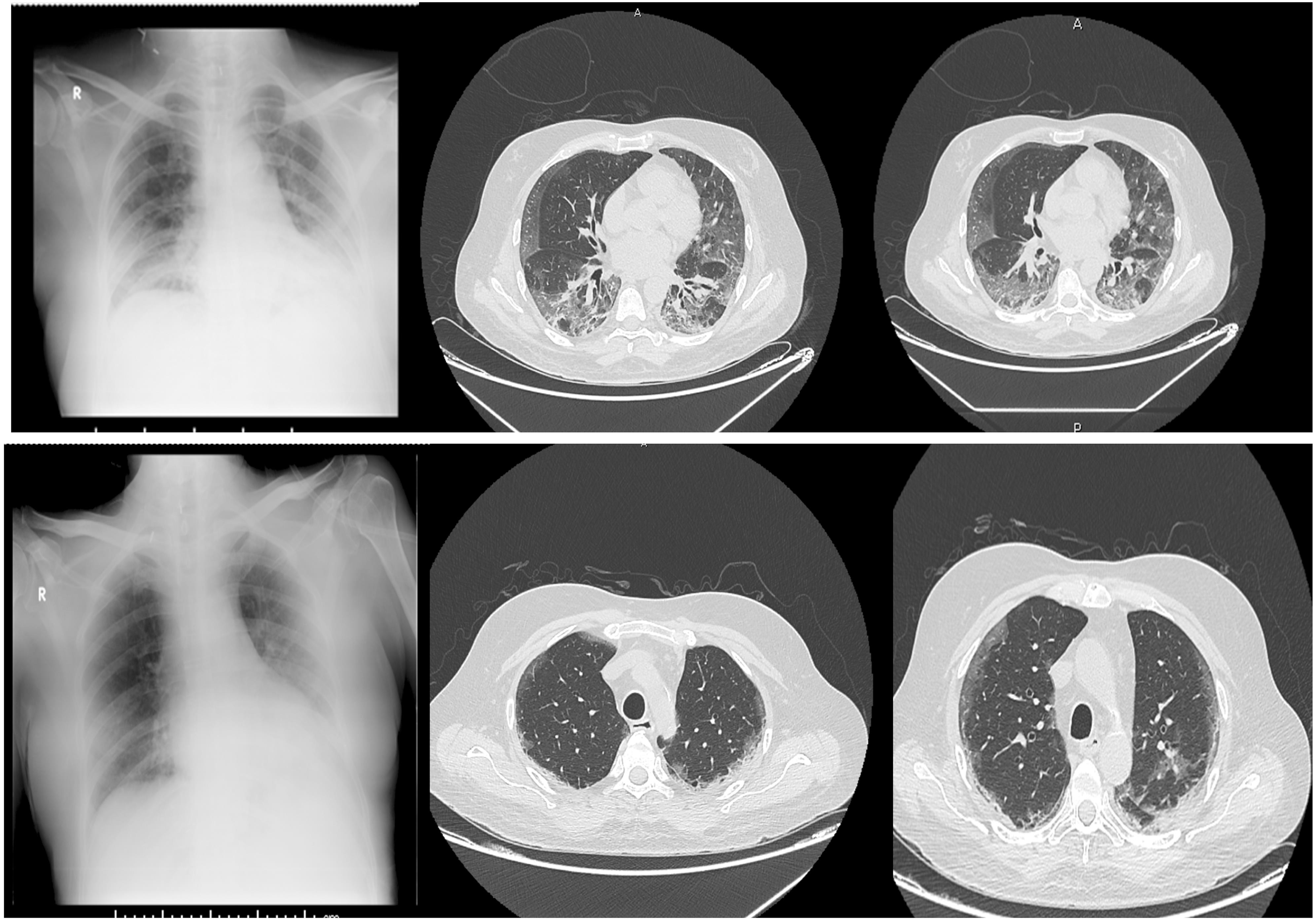 X ray of chest and CT Thorax at admission (upper panel) and on day 10 (lower panel) which showed improvement, post tocilizumab and convalescent plasma of COVID-19.