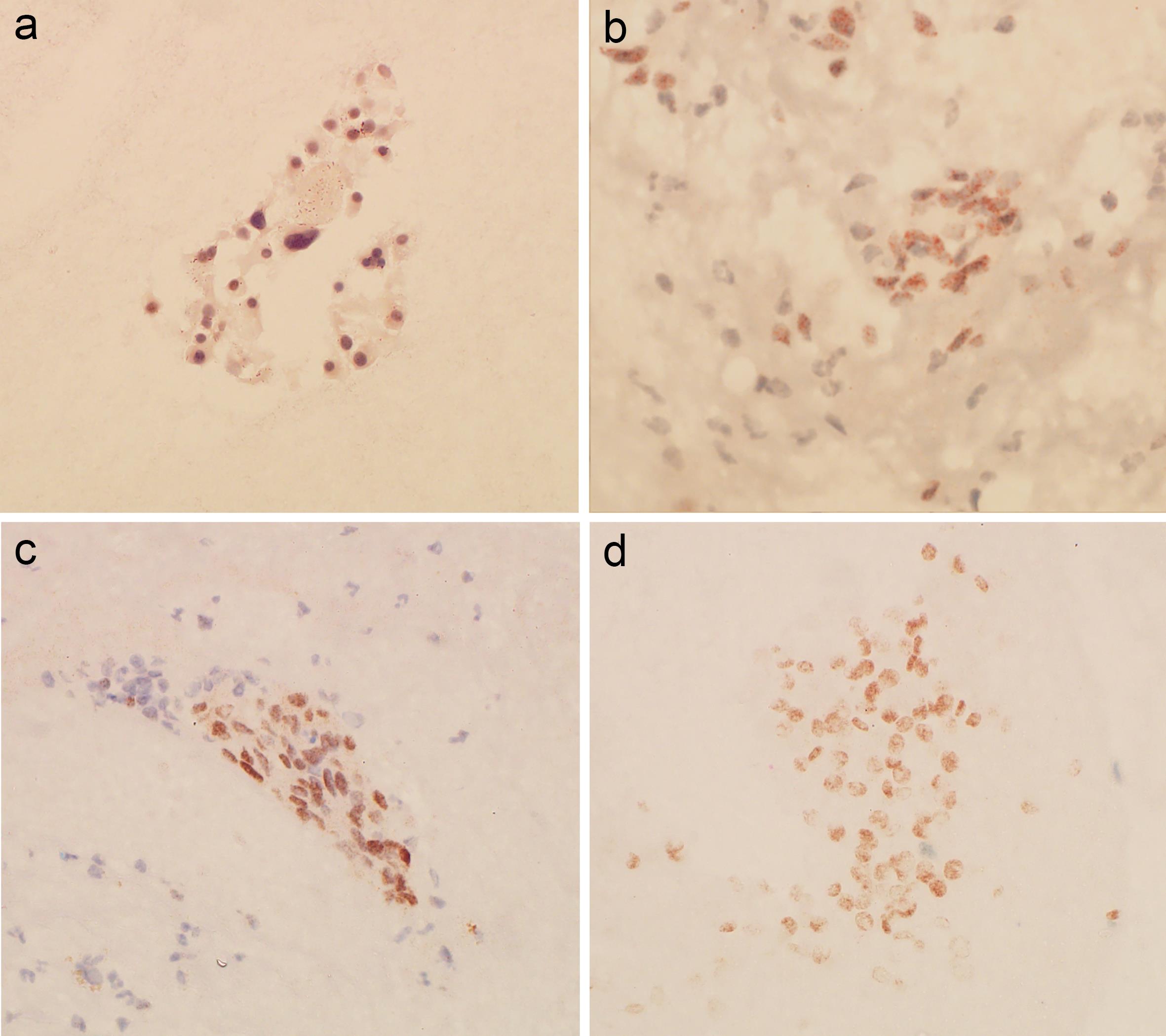 Pituitary homeobox 2 (PITX2) immunostaining results in medullary thyroid carcinoma (MTC) cytological samples.