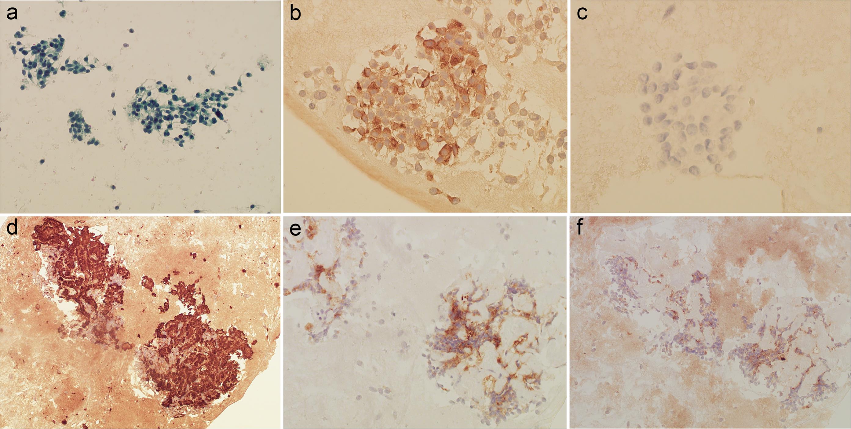 Morphology and immunohistochemical profile of medullary thyroid carcinoma cytological specimens.