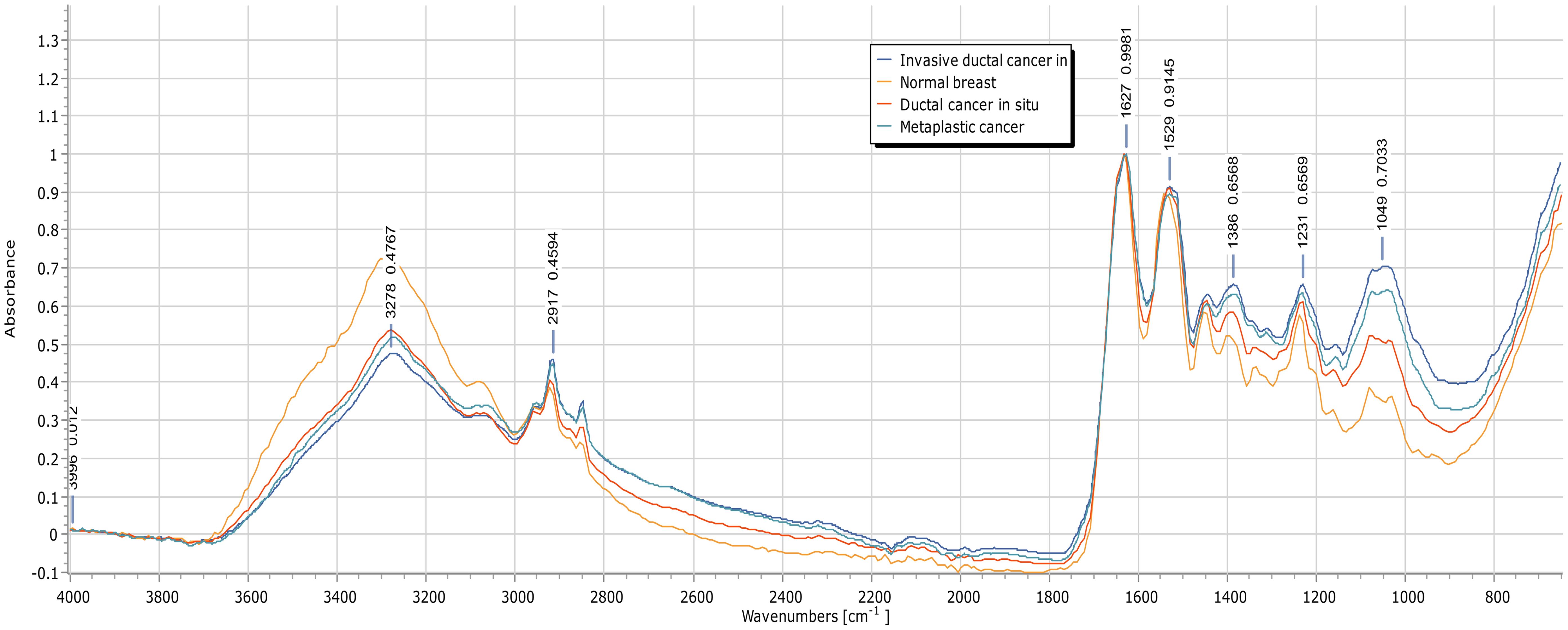 Spectral peaks discriminating between normal breast, ductal carcinoma <italic>in situ</italic>, invasive ductal carcinoma, and metaplastic carcinoma.