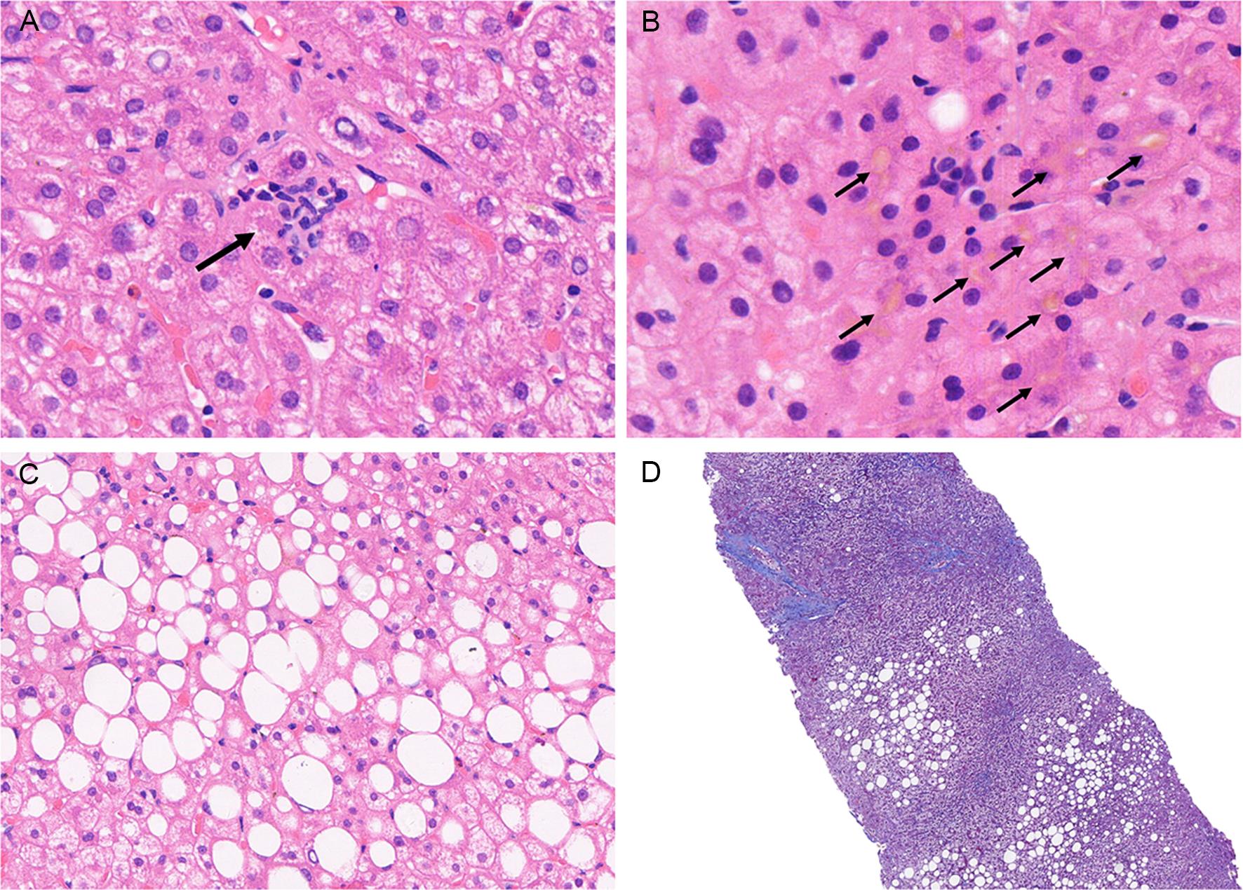 Microphotographs showing (A) focal necrosis (black arrow; 400×); (B) cholestasis (black arrows; 400×); (C) fatty degeneration of hepatocytes (200×); (D) Masson stain positive (4×).