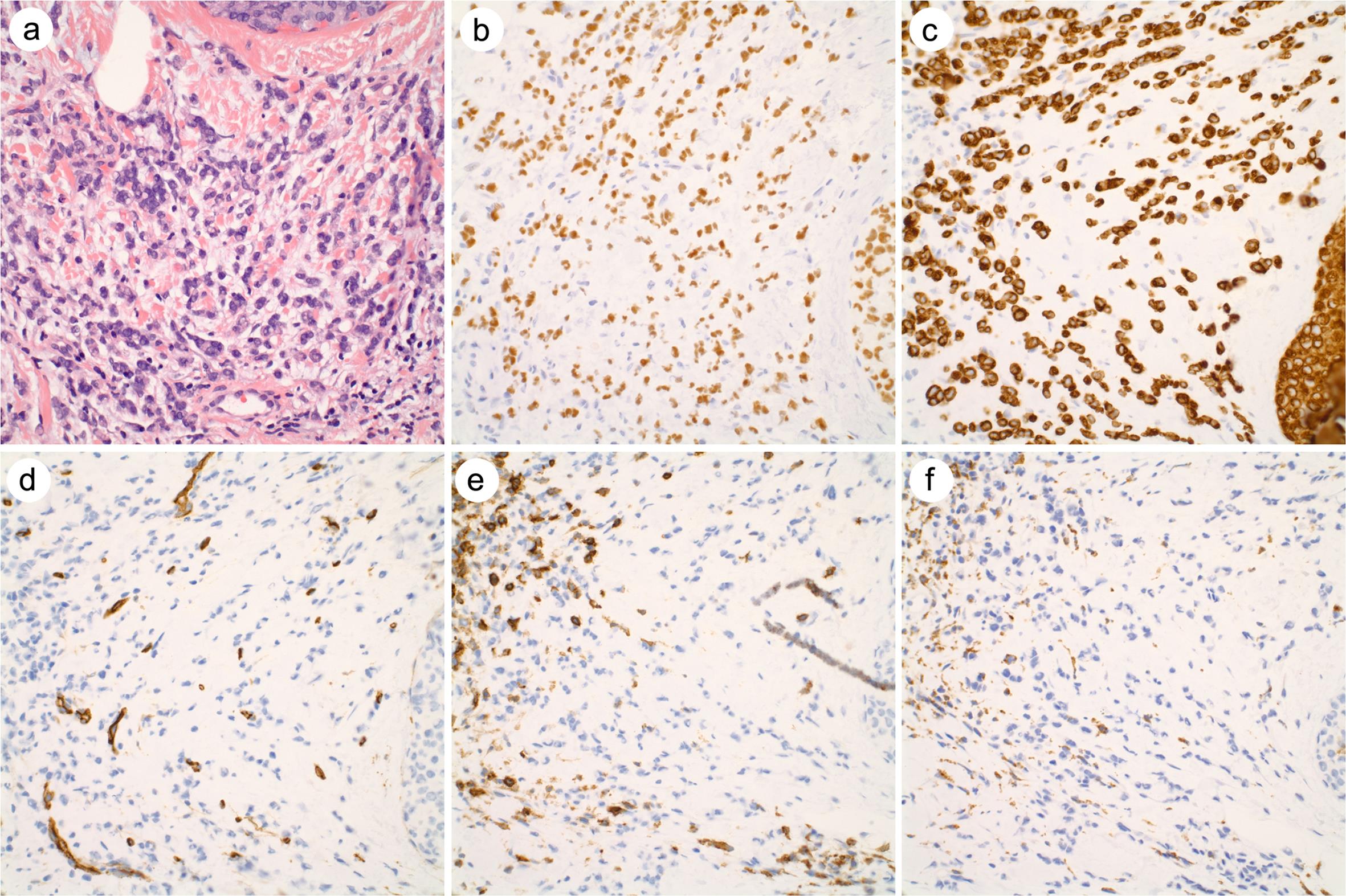 An example of invasive lobular carcinoma with high background of non-tumor cells.