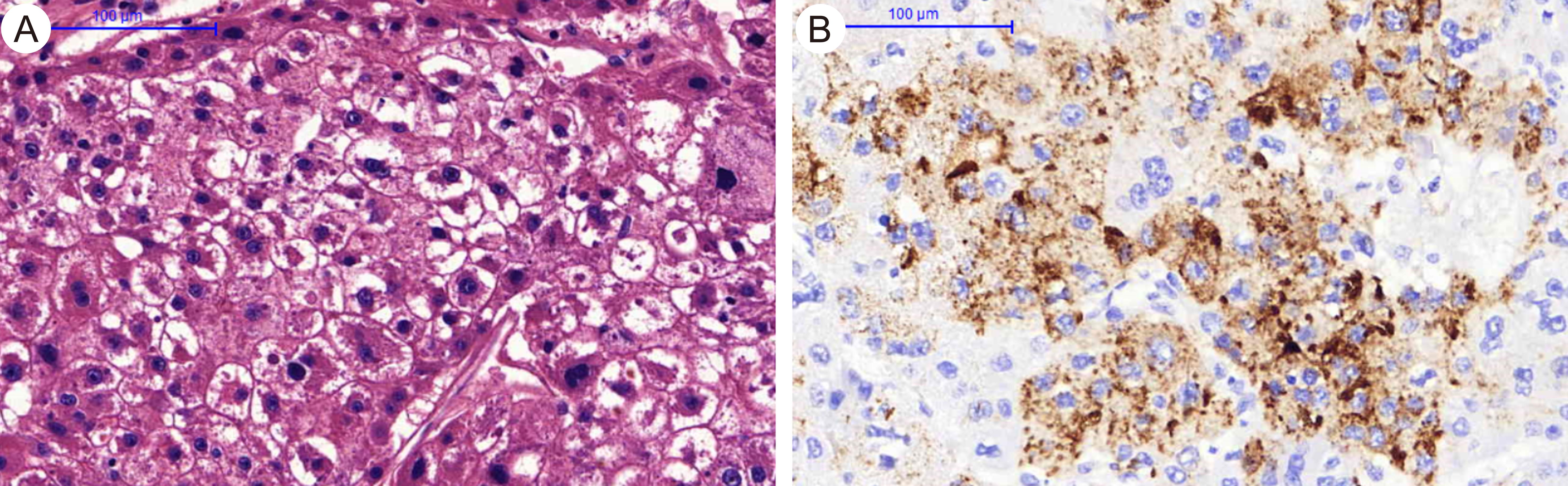 IHC studies of the liver HCC resected in 2009.