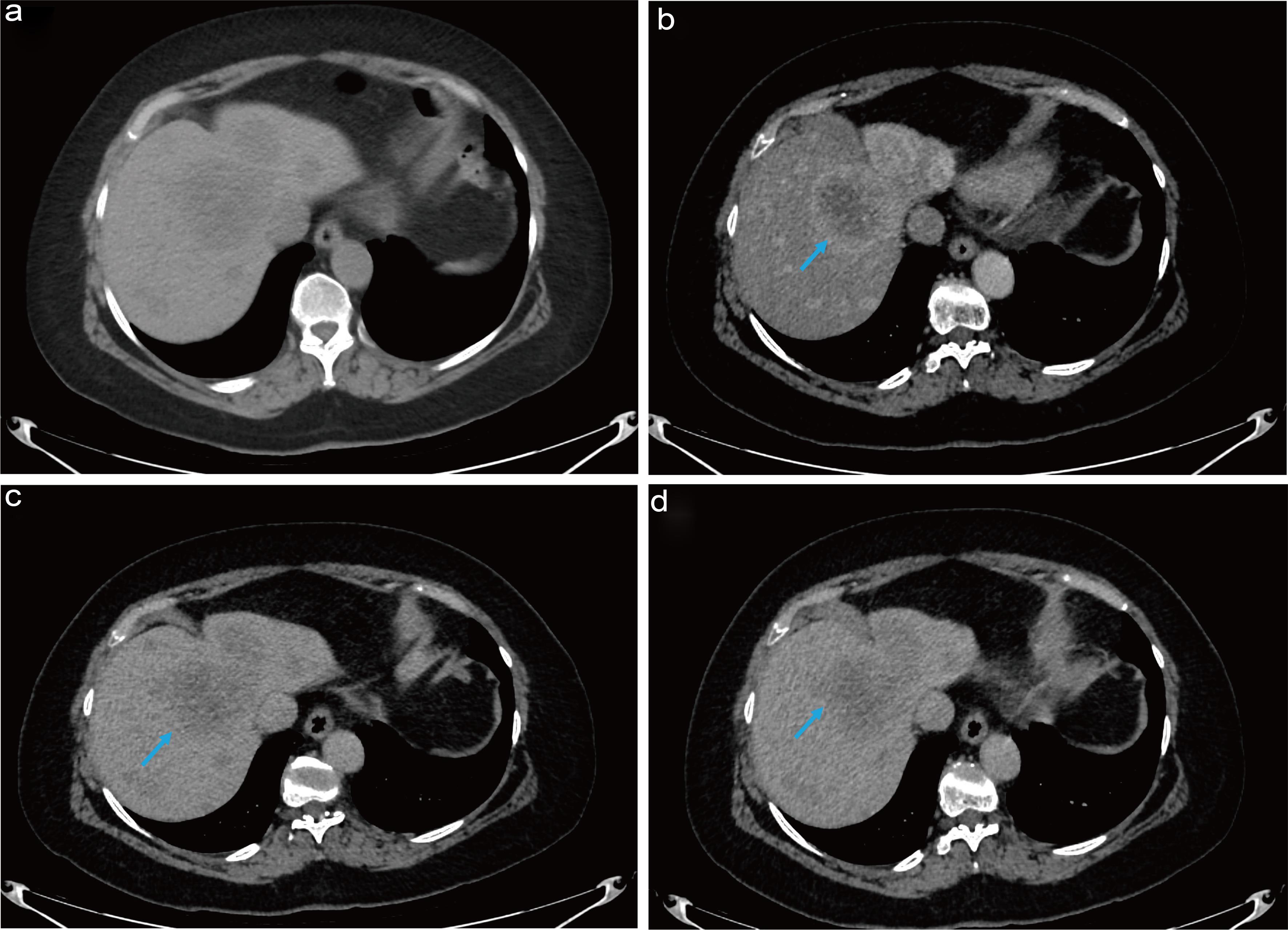 Baseline CT imaging (a) non-contrast enhanced, and contrast enhanced- (b) arterial phase demonstrating hyperenhancement, (c) and (d) portal venous phase demonstrating washout.