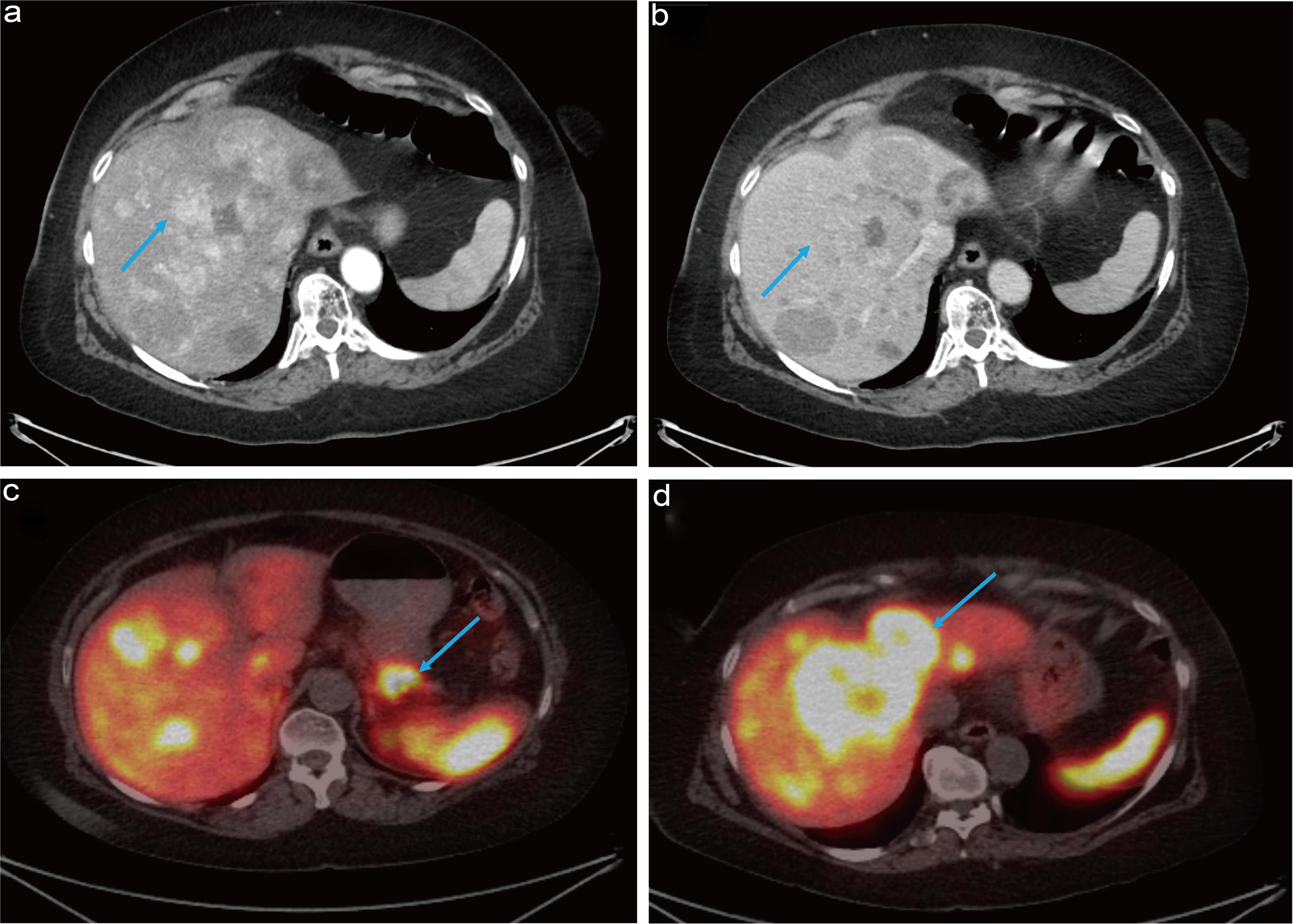 Subsequent CT scan (a) contrast enhanced- arterial phase, (b) portal venous phase, PET scan (c) DOTATATE avid pancreatic lesion, (d) DOTATATE avid liver metastases.