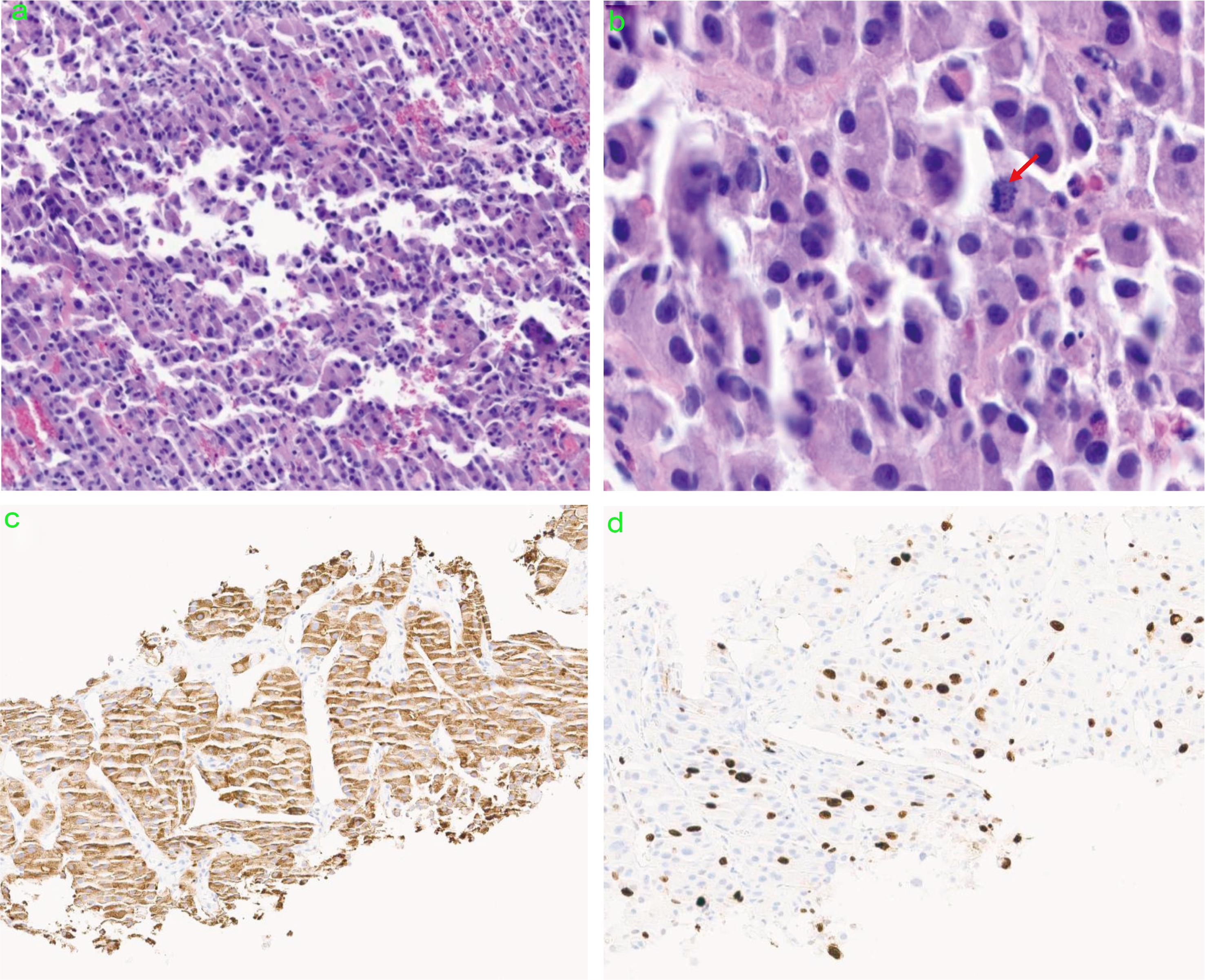 Pathology from liver biopsy (a) H&E low power, (b) high power showing a mitotic figure, (c) positive synaptophysin stain, (d) Ki67.