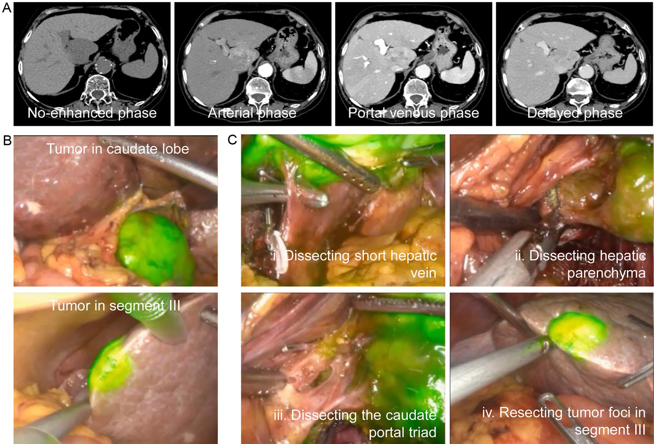 A representative HCC patient performed ICG-based fluorescence-guided surgery.