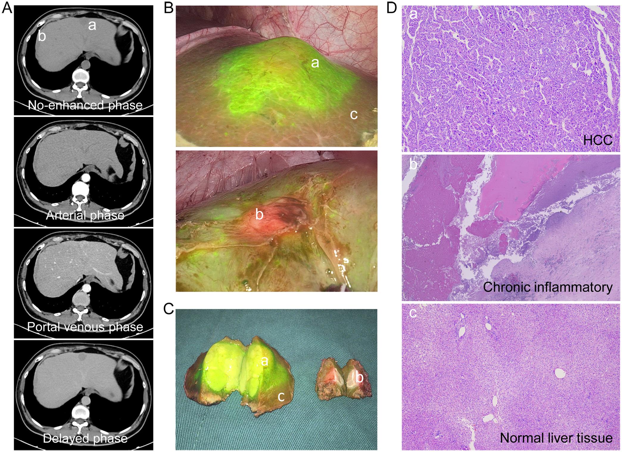 A representative case of intraoperative identification of a HCC lesion and non-tumoral lesions using ICG-based fluorescence imaging.