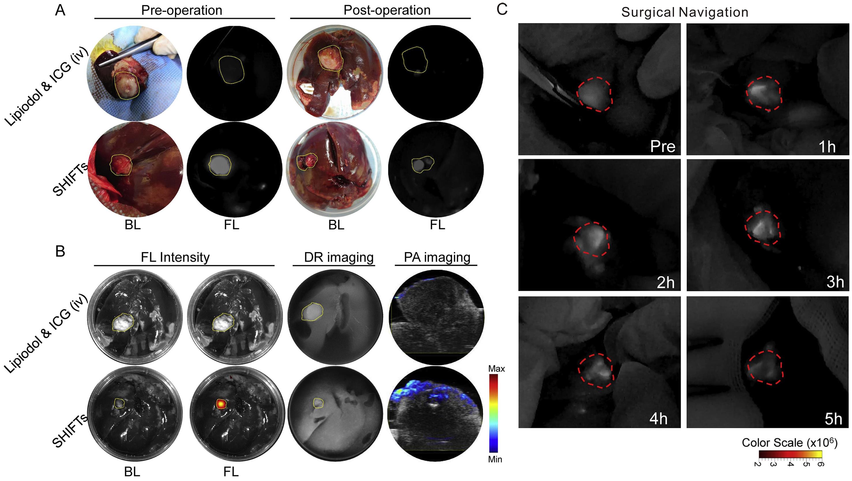 Fluorescence-guided tumor resection in vivo after interventional treatment with super-stable homogeneous intermixed formulation technologies or normal lipiodol & ICG before surgery.