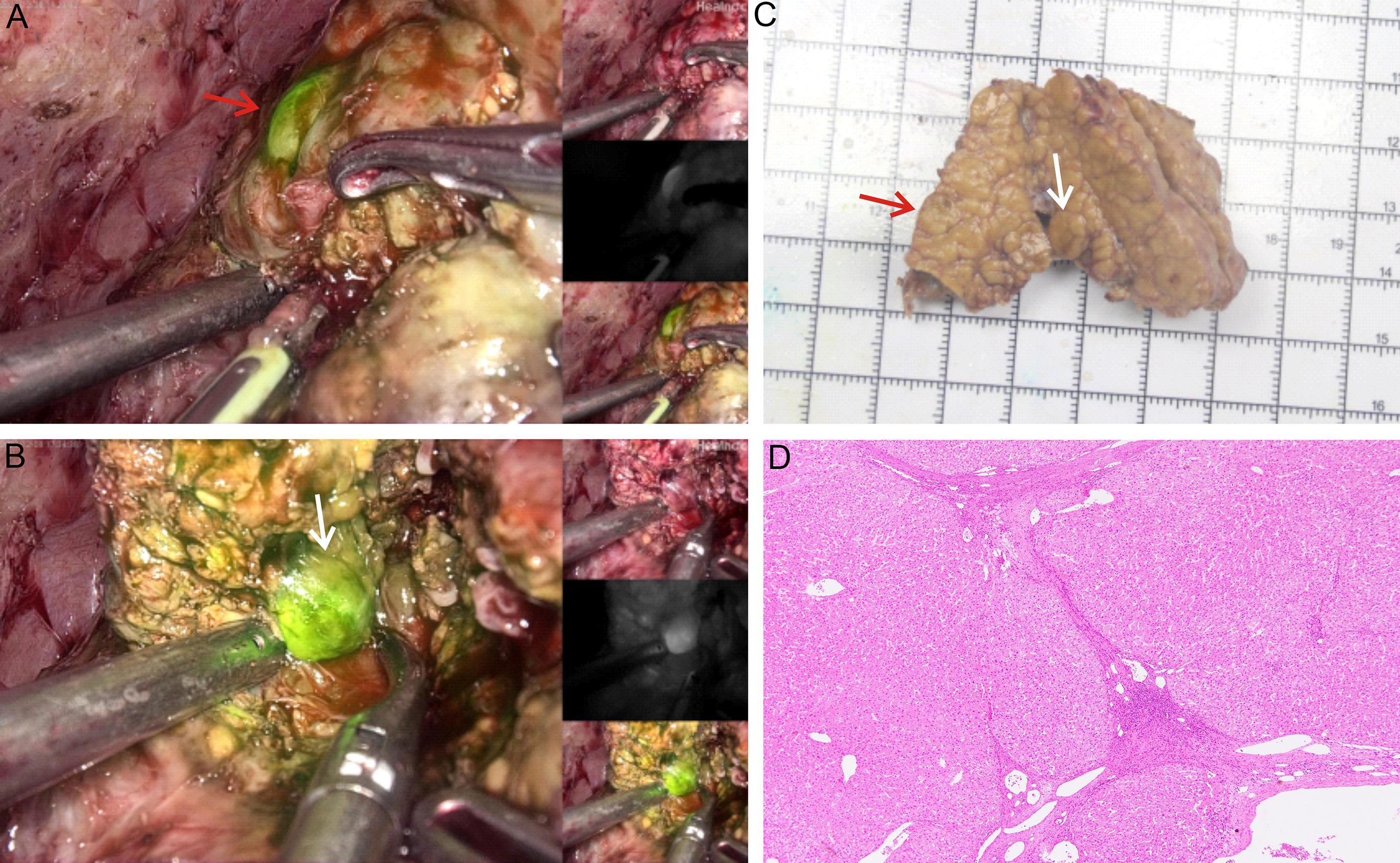 Fluorescence imaging of false-positive nodules in liver cirrhosis after preoperative intravenous injection of indocyanine green.