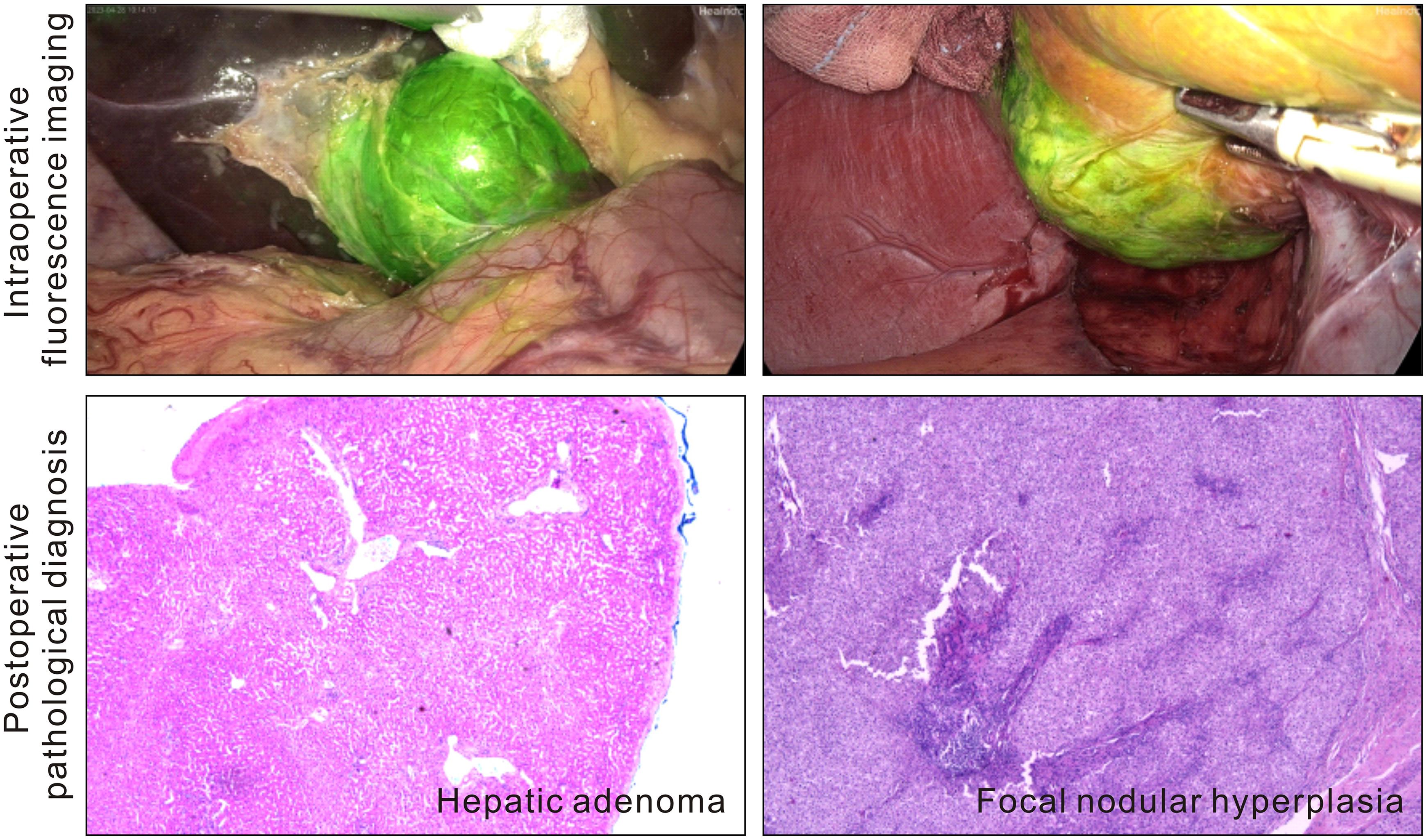 Fluorescence imaging of benign liver tumors through preoperative intravenous injection of indocyanine green.