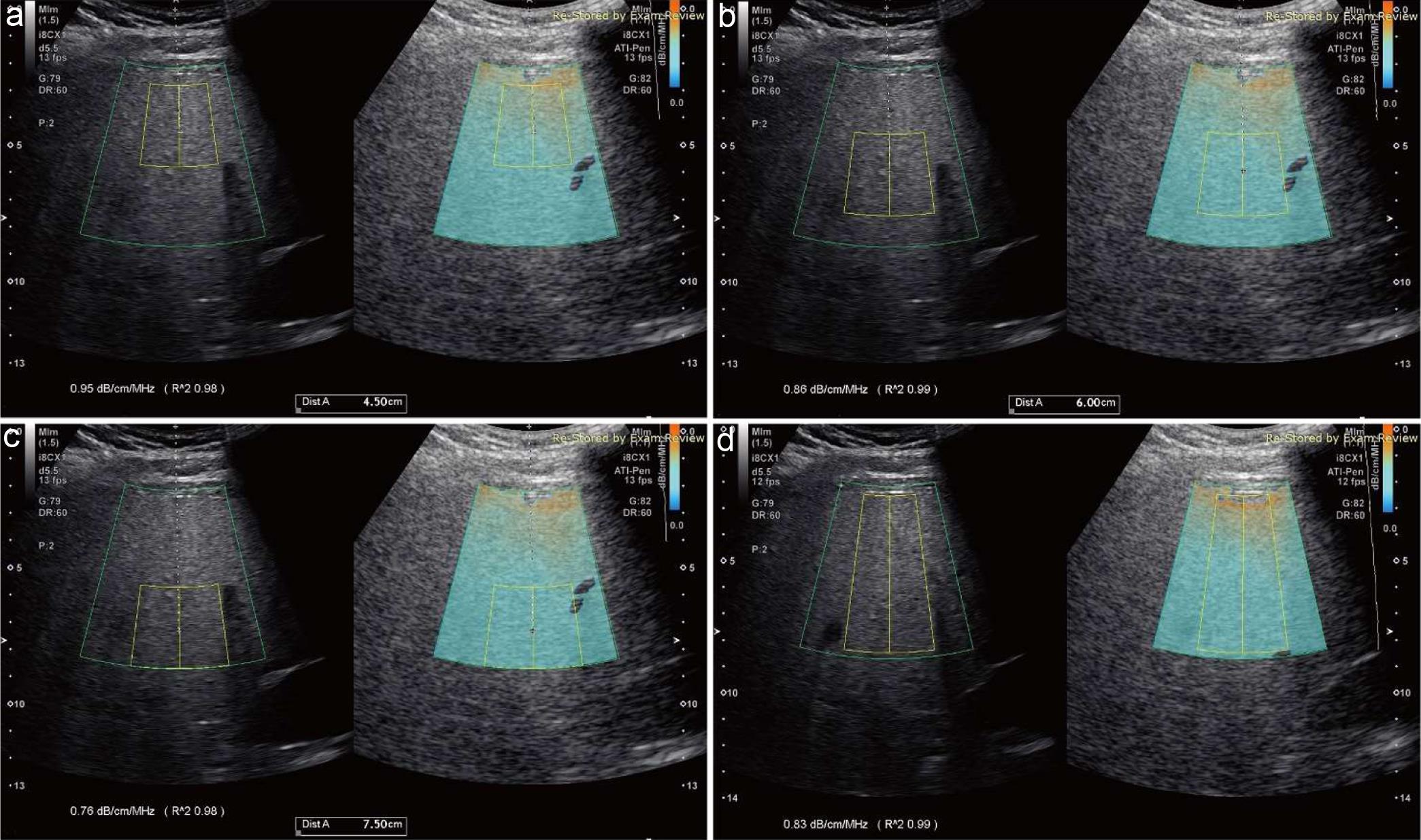 Ultrasound attenuation coefficient (AC, dB/cm/MHz) is measured using two sizes of the region of interest (ROI).