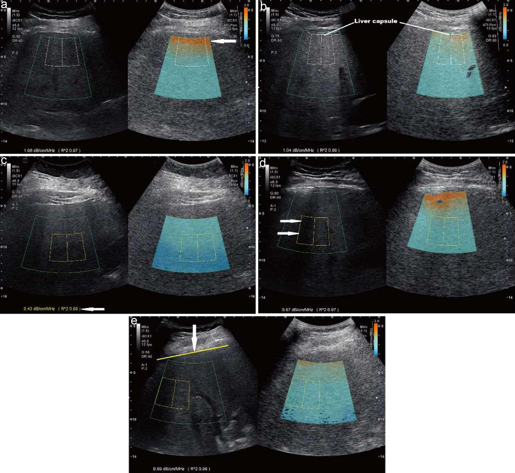 Technical errors in measuring liver attenuation coefficient (AC).