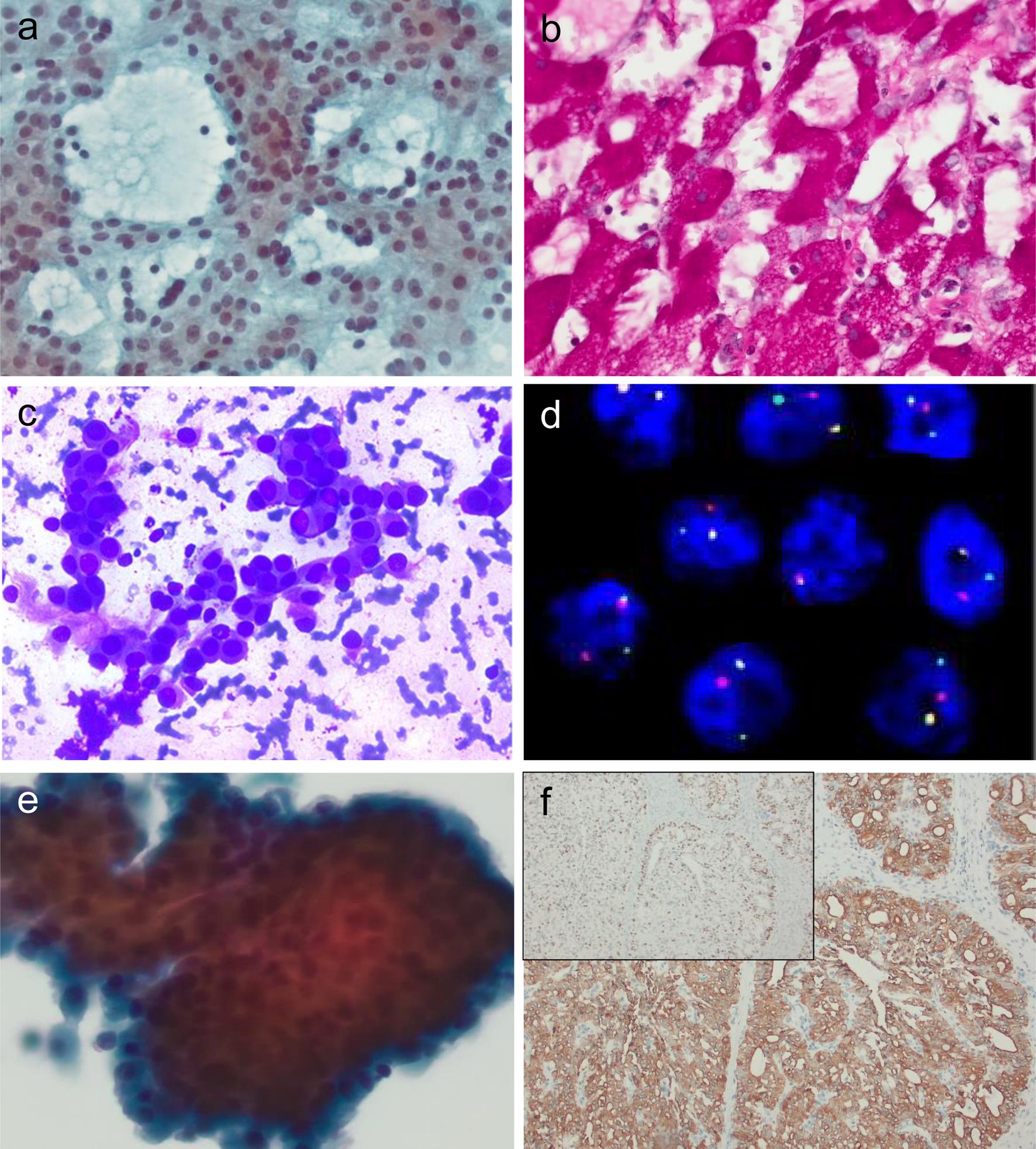 Cytomorphologic features and ancillary tests of malignant salivary gland tumors.