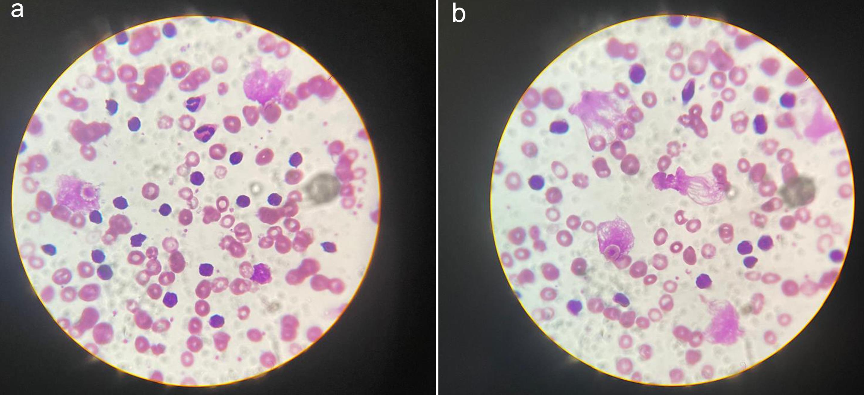 Blood film (×100) showing leukocytosis with characteristic small mature-looking lymphocytes (a), and numerous smear/smudge cells, small lymphocytes, and a spindle-shaped lymphocyte (b).