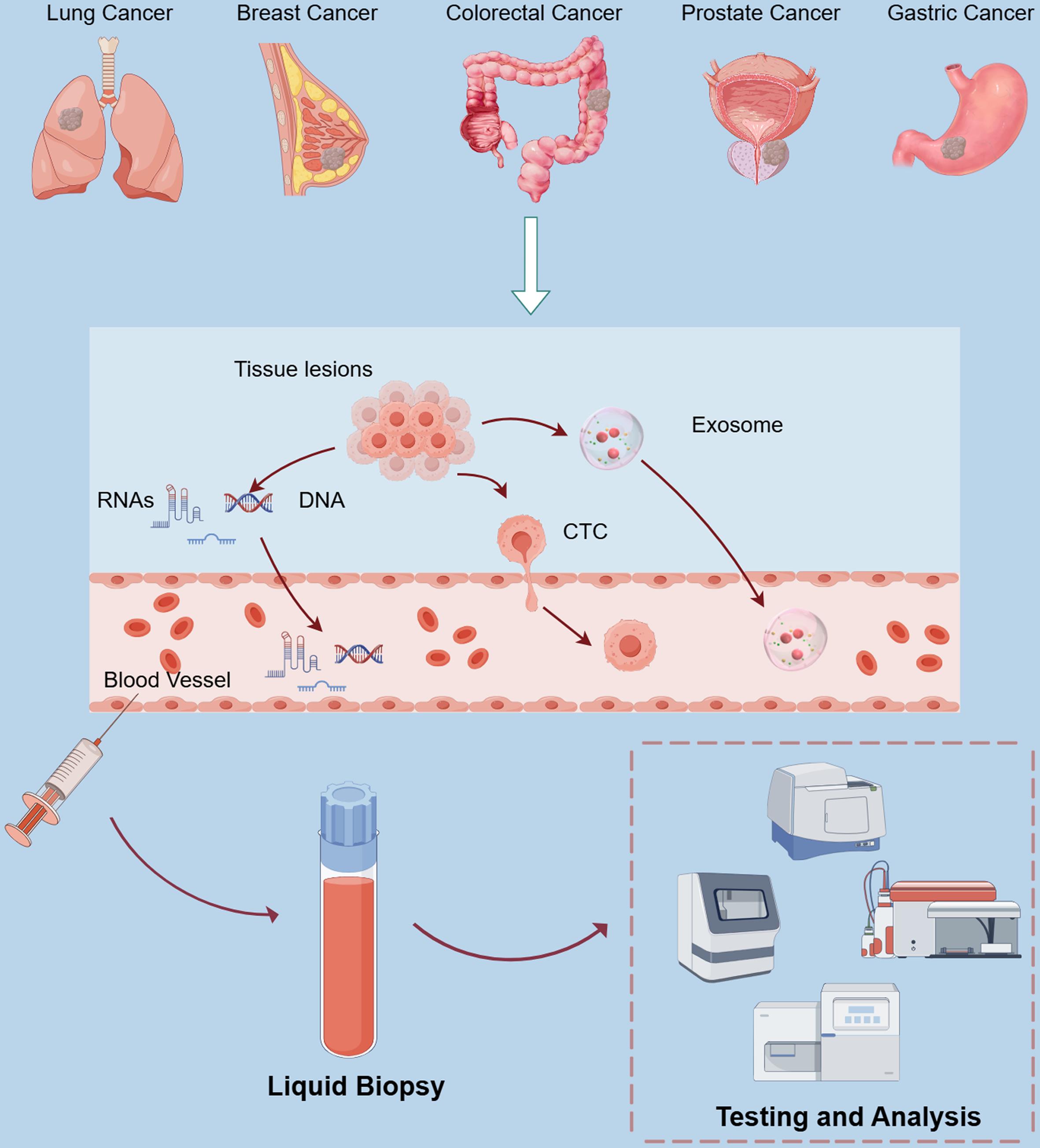 Liquid biopsy workflow in cancer detection and analysis.