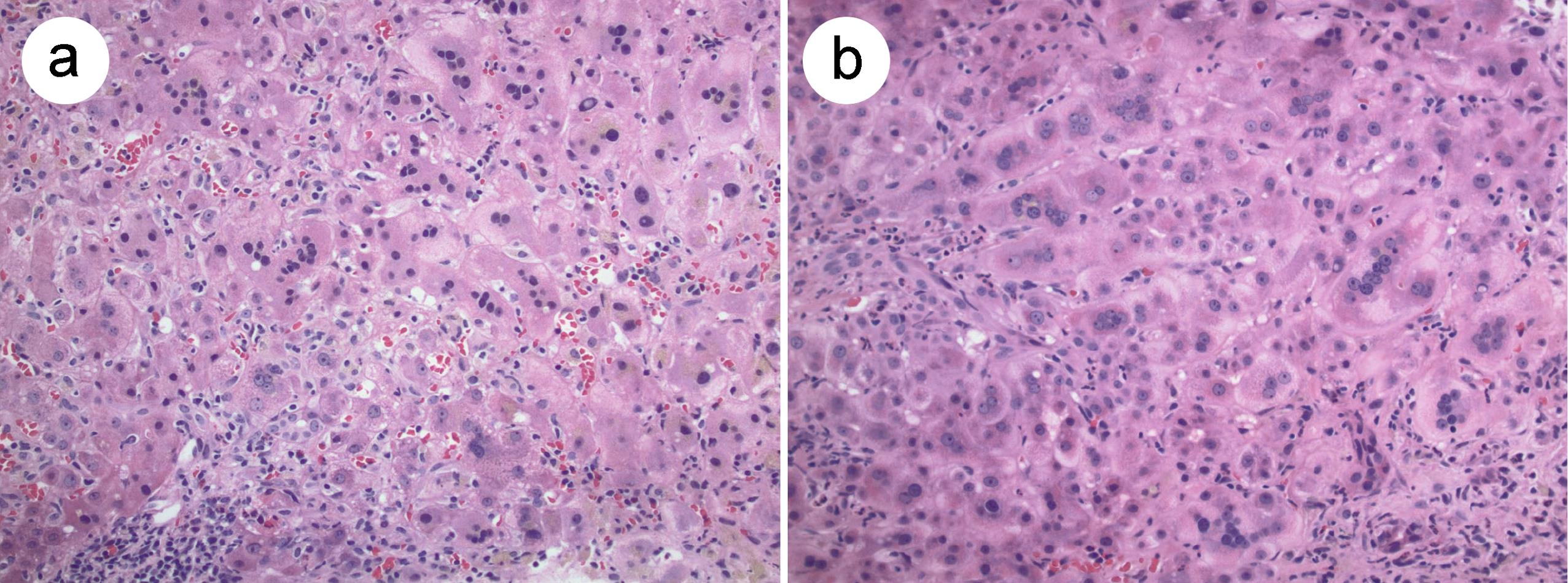 Representative images of post-infantile giant cell hepatitis.