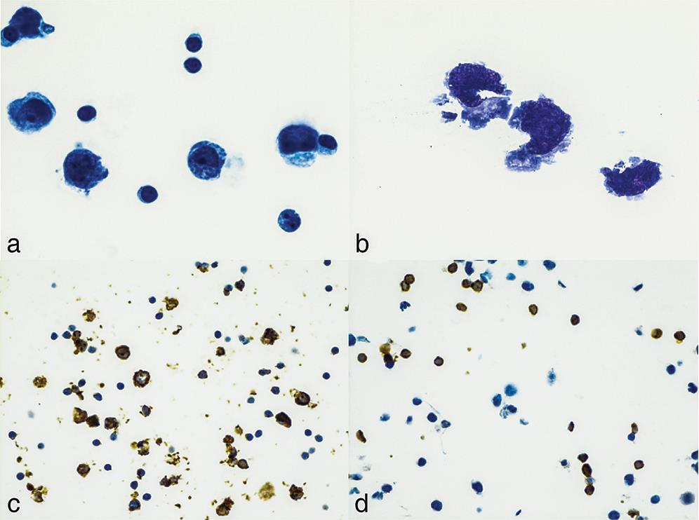 Ascitic fluid cytology from a patient with chylous ascites.