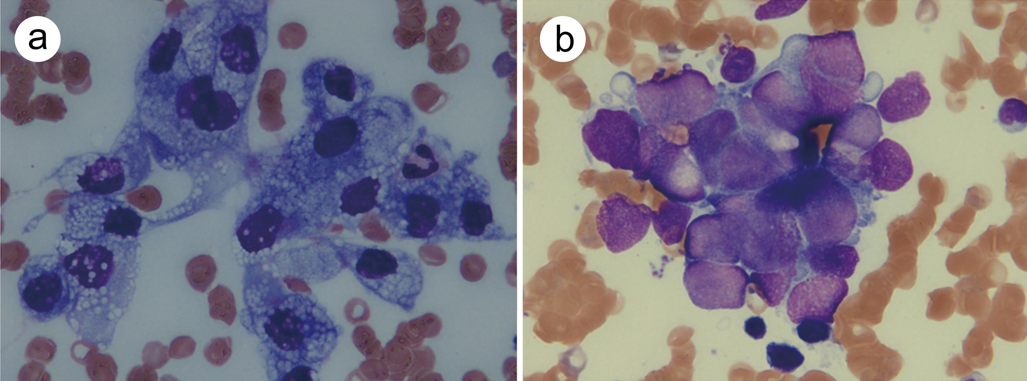 Bone marrow smear revealed (a) Case 1, poorly differentiated adenocarcinoma; (b) Case 2, undifferentiated carcinoma (May Giemsa stain; original magnification, ×1,000).