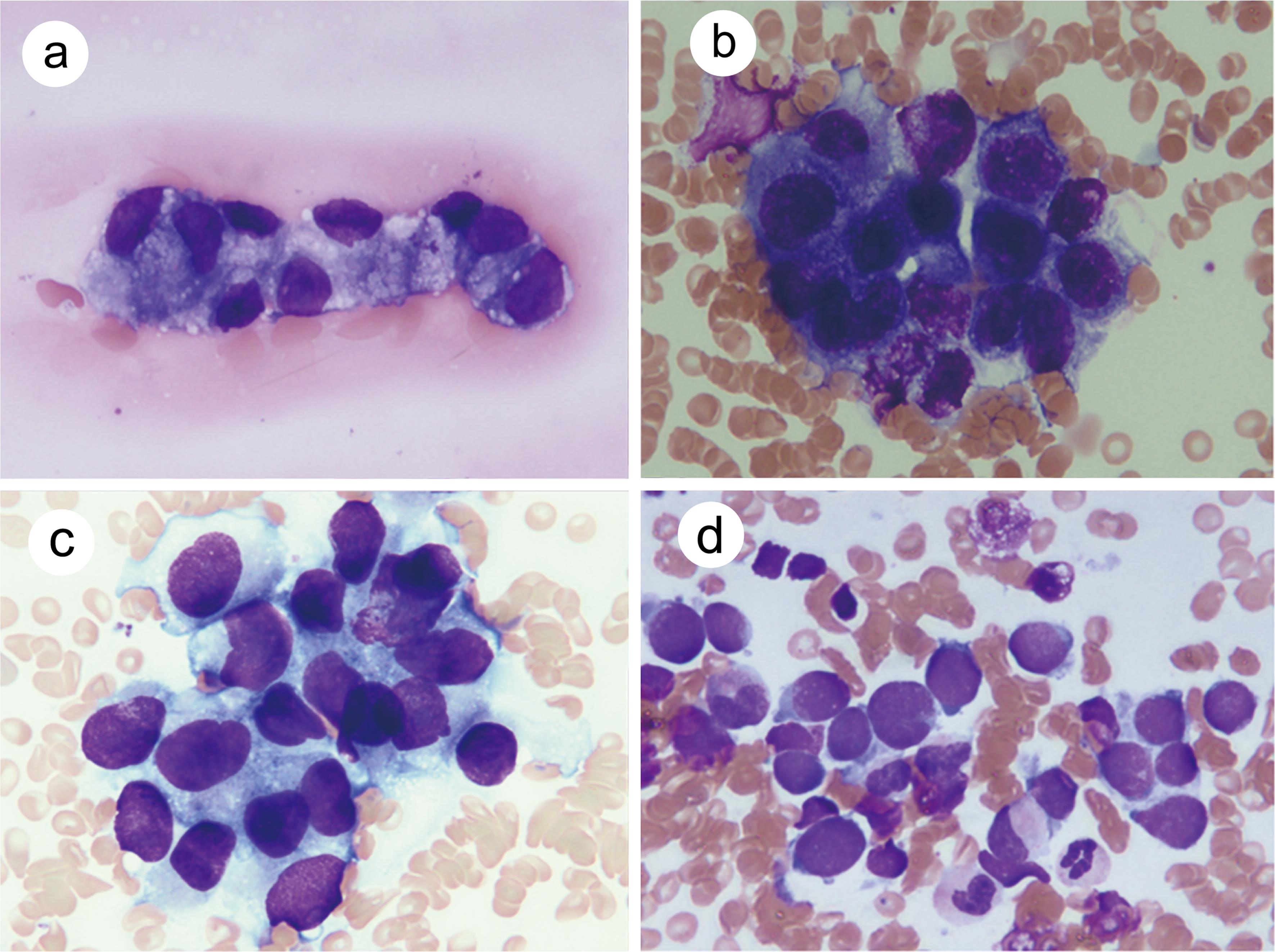 Bone marrow smear was used to detect (a) Case 3, adenocarcinoma of gastric carcinoma; (b) Case 4, adenocarcinoma of gastric carcinoma; (c) Case 7, urothelial carcinoma; and (d) small cell carcinoma of the lung (May Giemsa stain; original magnification, ×1,000).