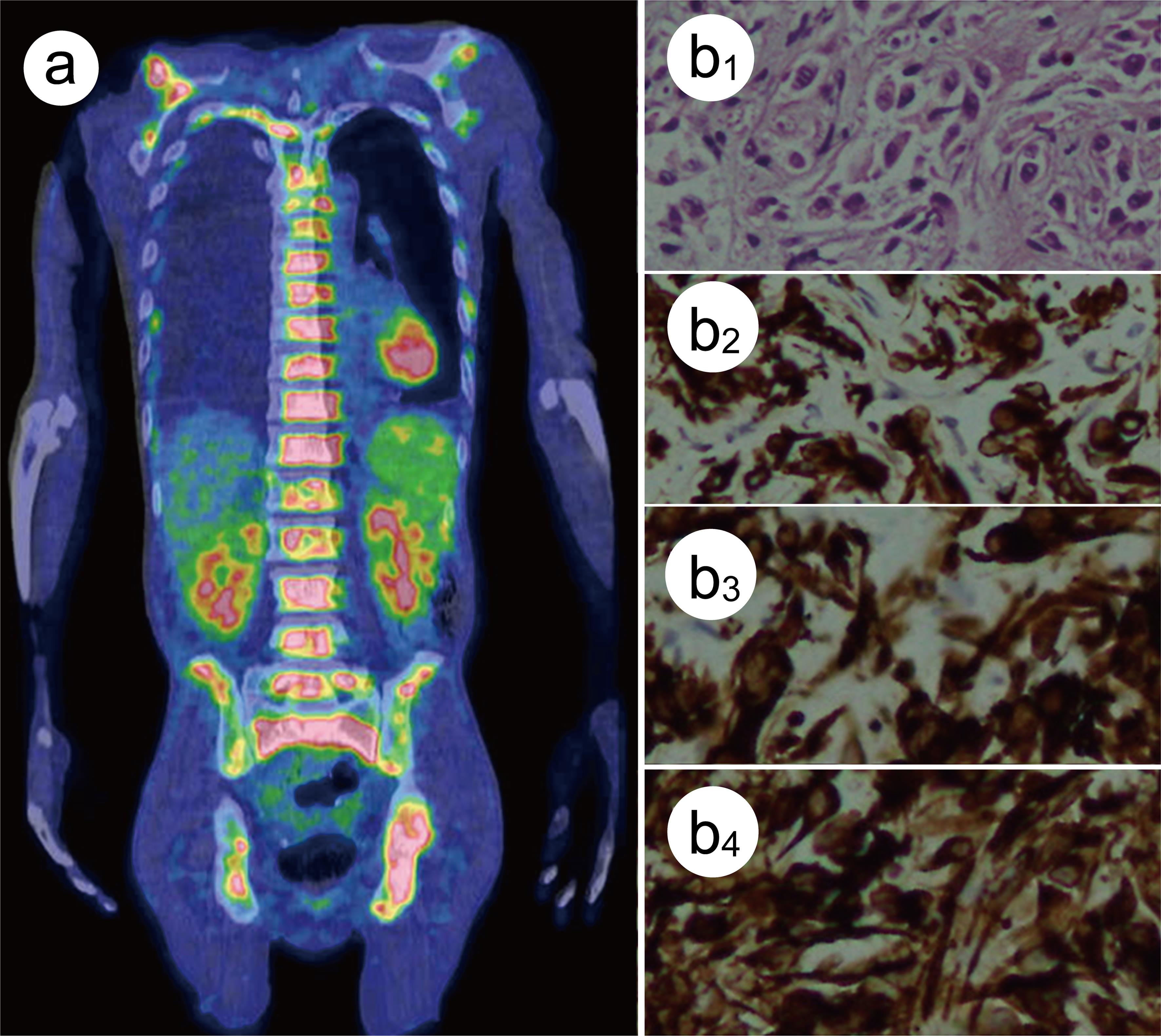 Imaging and bone marrow histopathological studies in Patient 1.