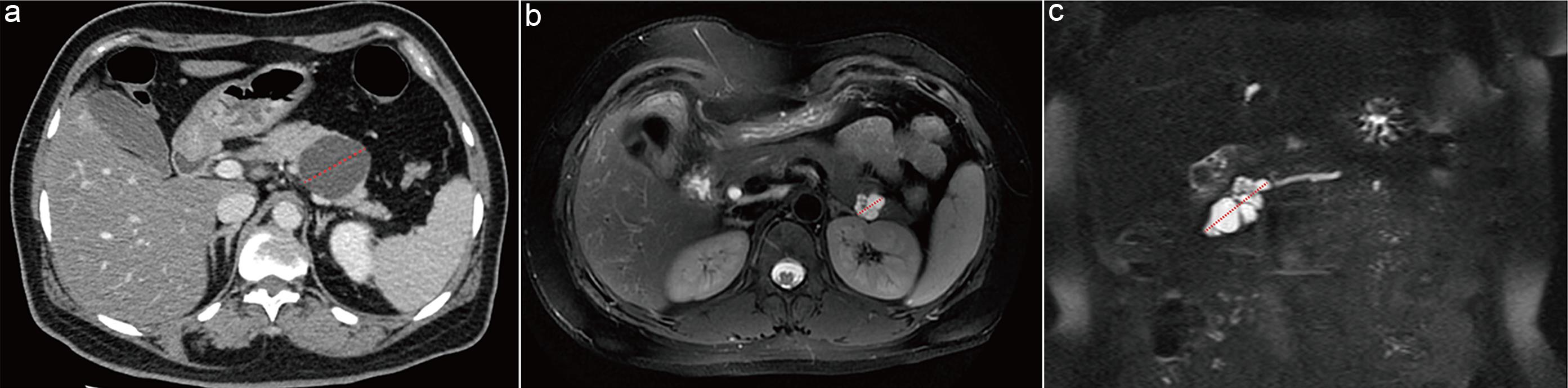 Measurement methods for pancreatic cystic neoplasms.