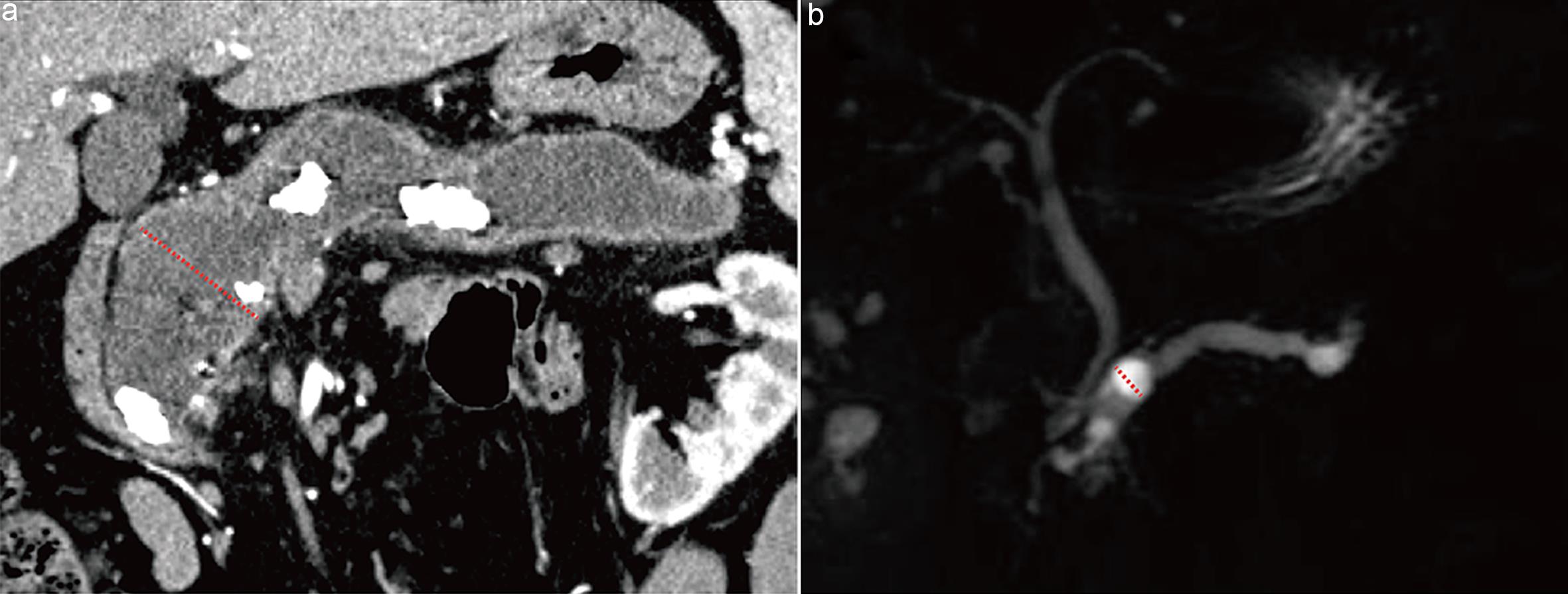 Methods for measuring the main pancreatic duct (MPD) diameter.