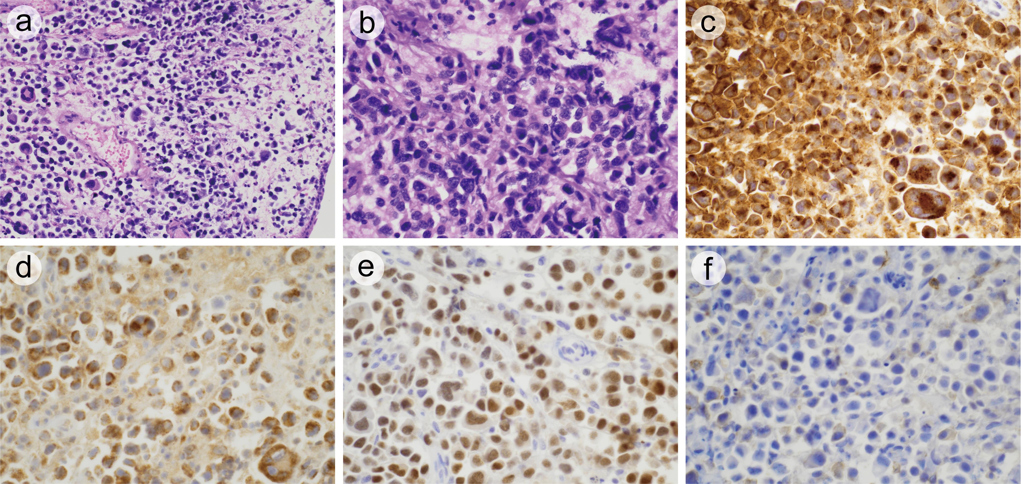 Bladder mass excisional biopsy.