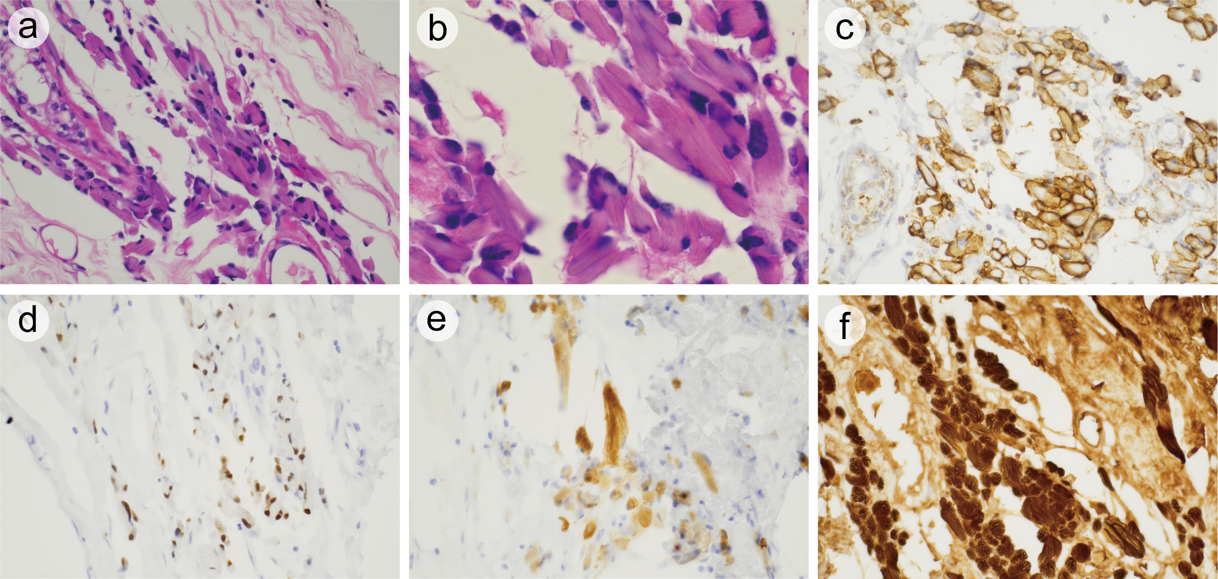 Breast lumpectomy.