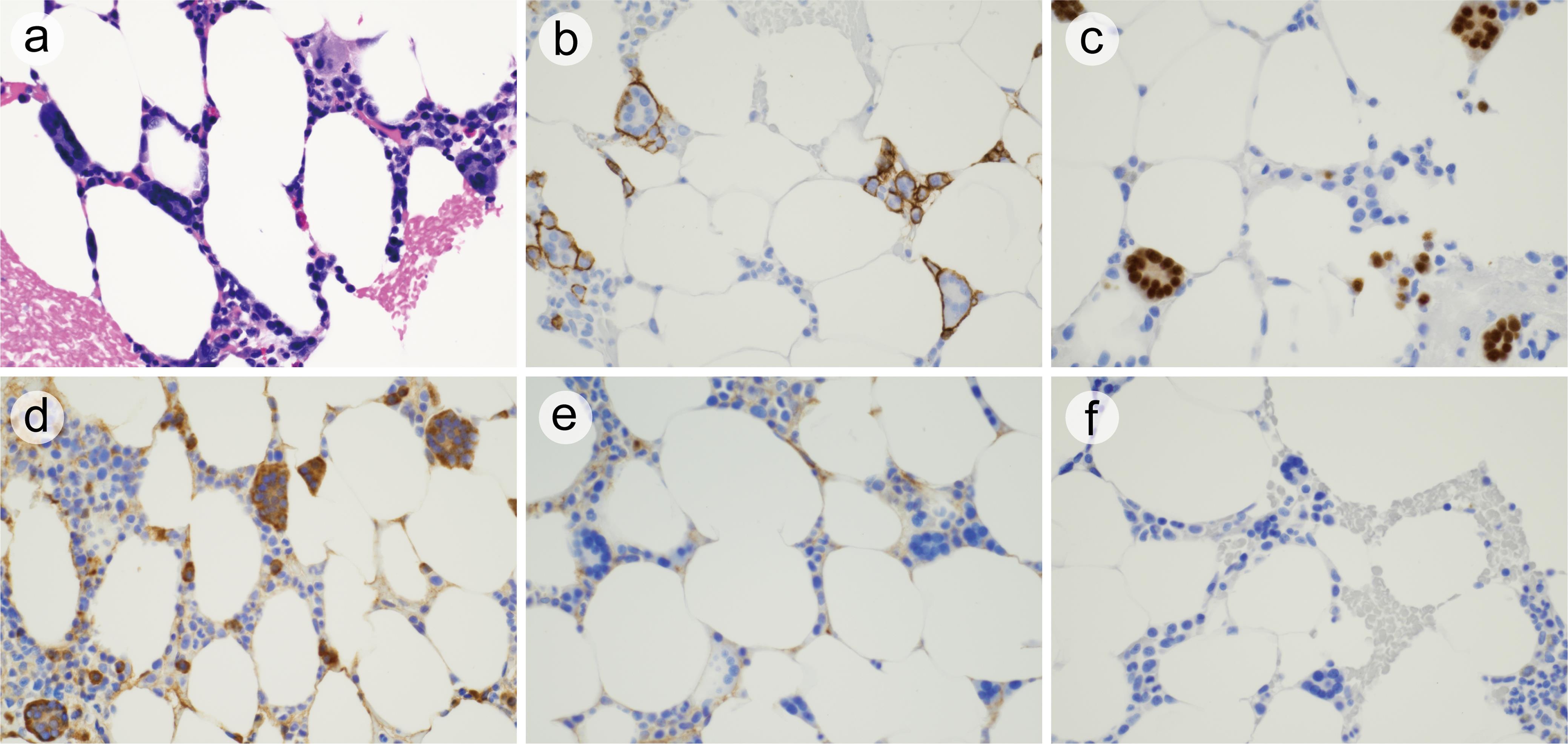 Bone marrow biopsy.