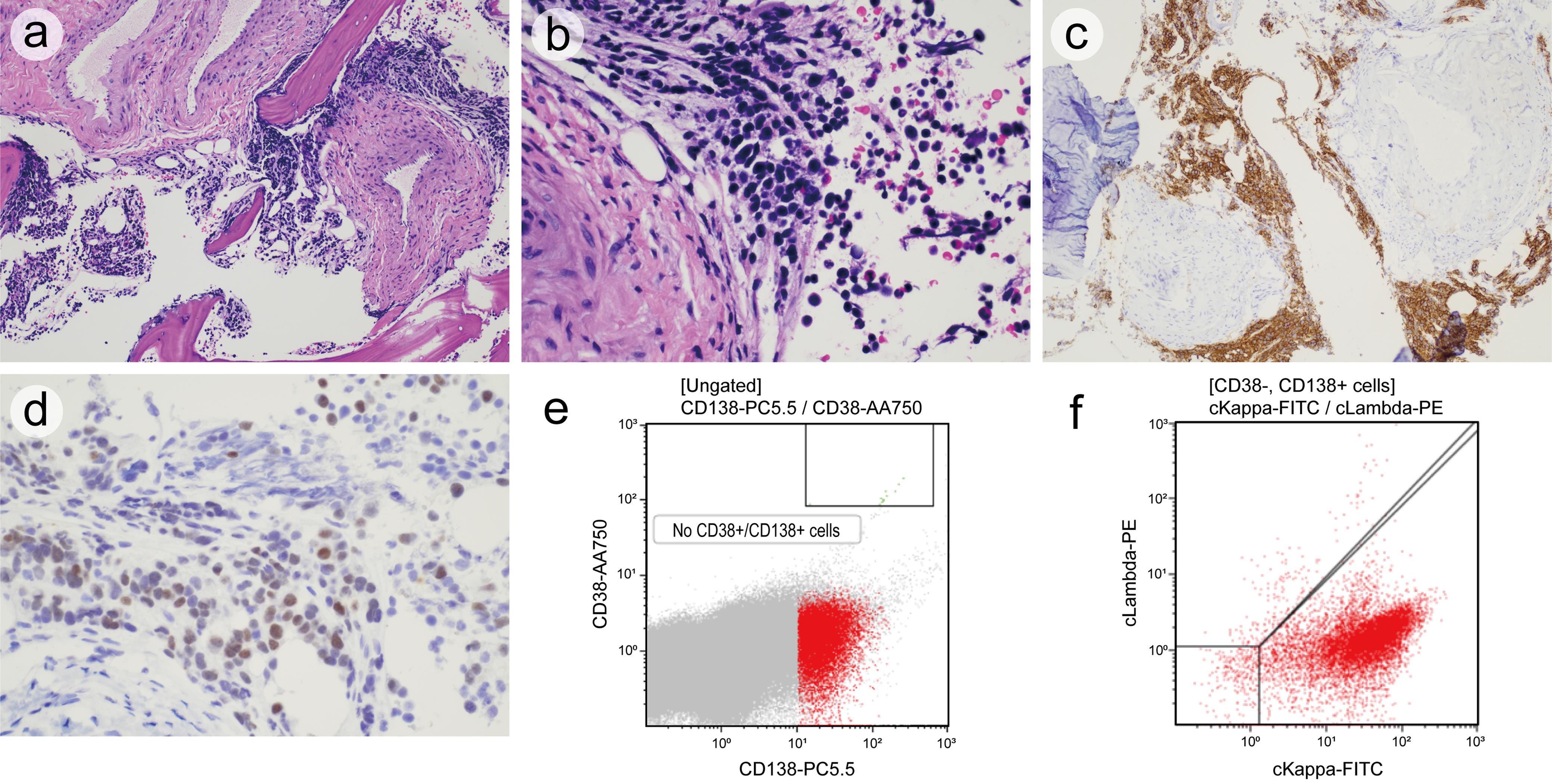 Bone marrow core biopsy.