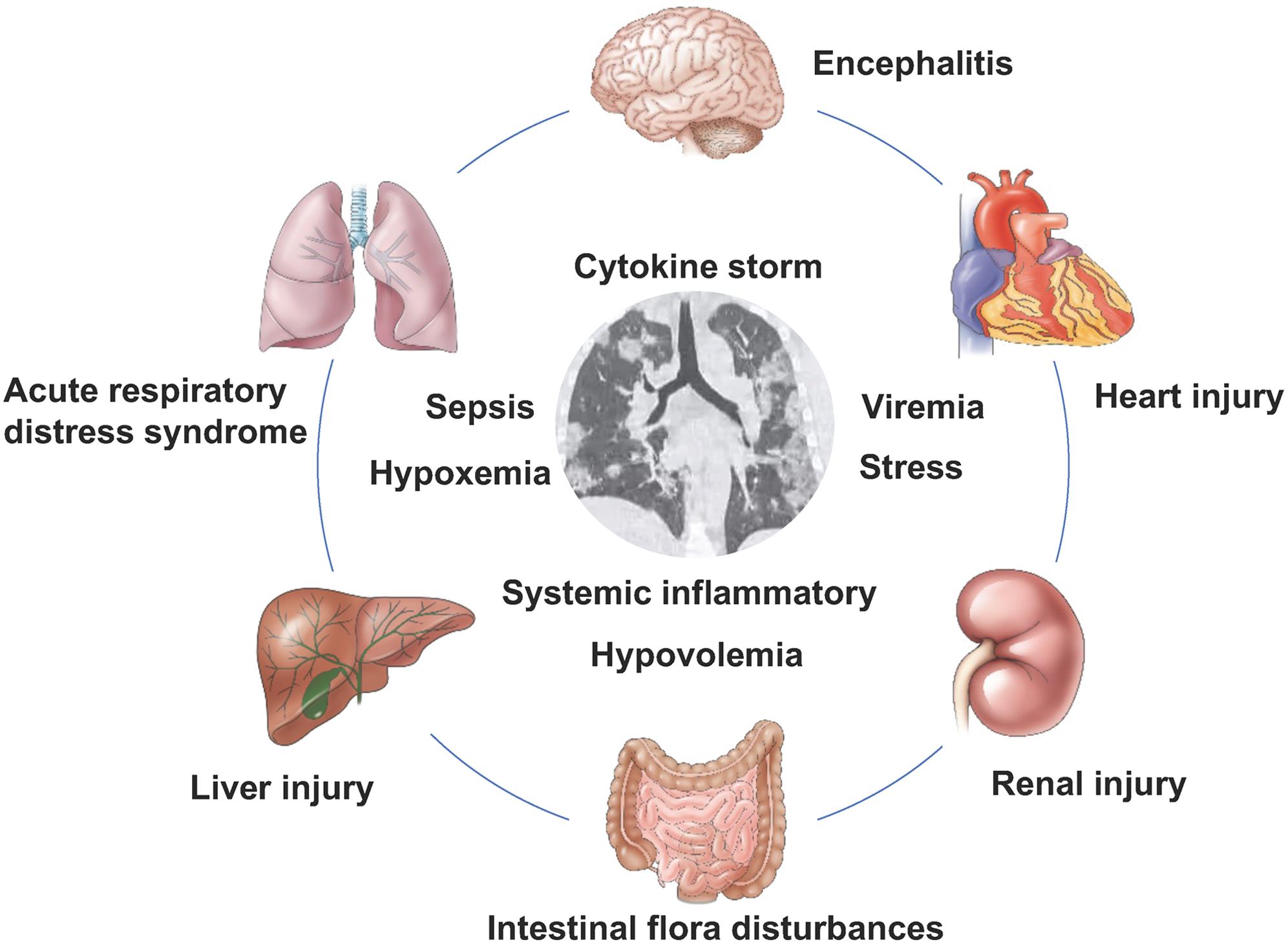 Complications and disease mechanisms in patients with 2019 coronavirus infection.