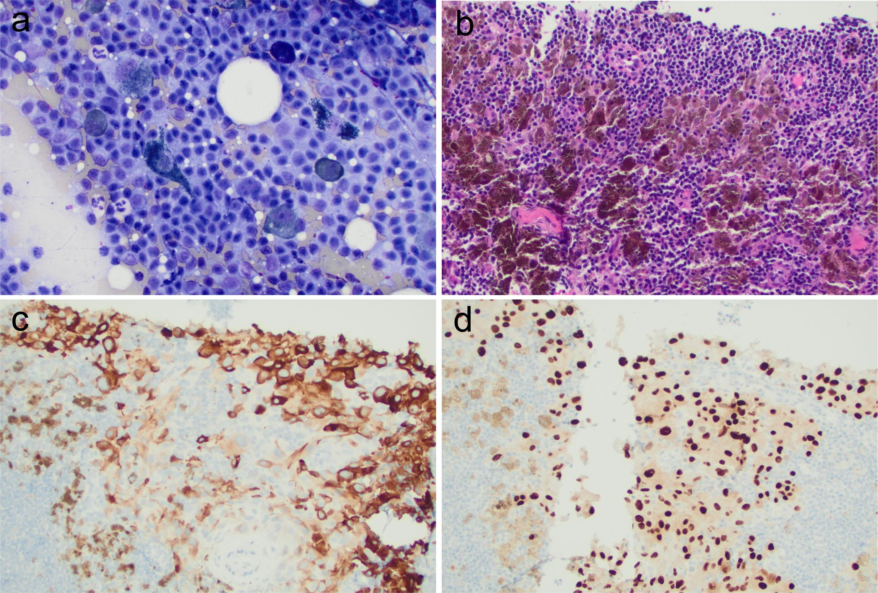 Introduction of the WHO Reporting System for Lymph Node Cytopathology