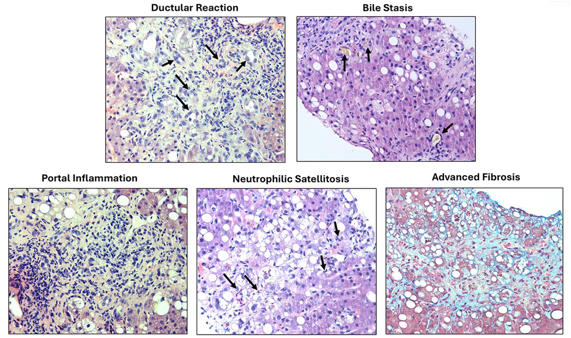 Representative histologic images showing alcohol liver pathology signature (ALPS).