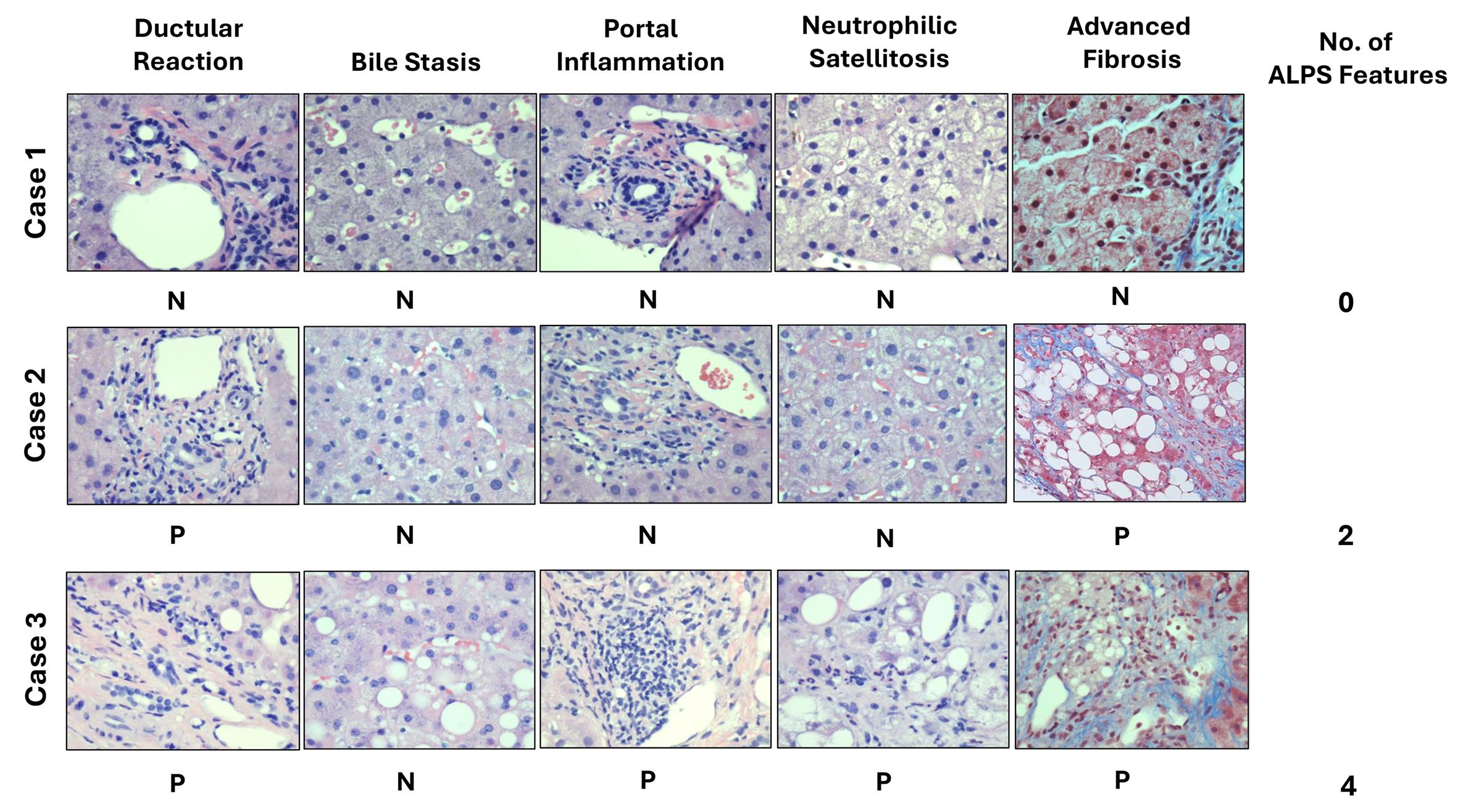 Spectrum of alcohol liver pathology signature (ALPS) features in selected MASLD cases.