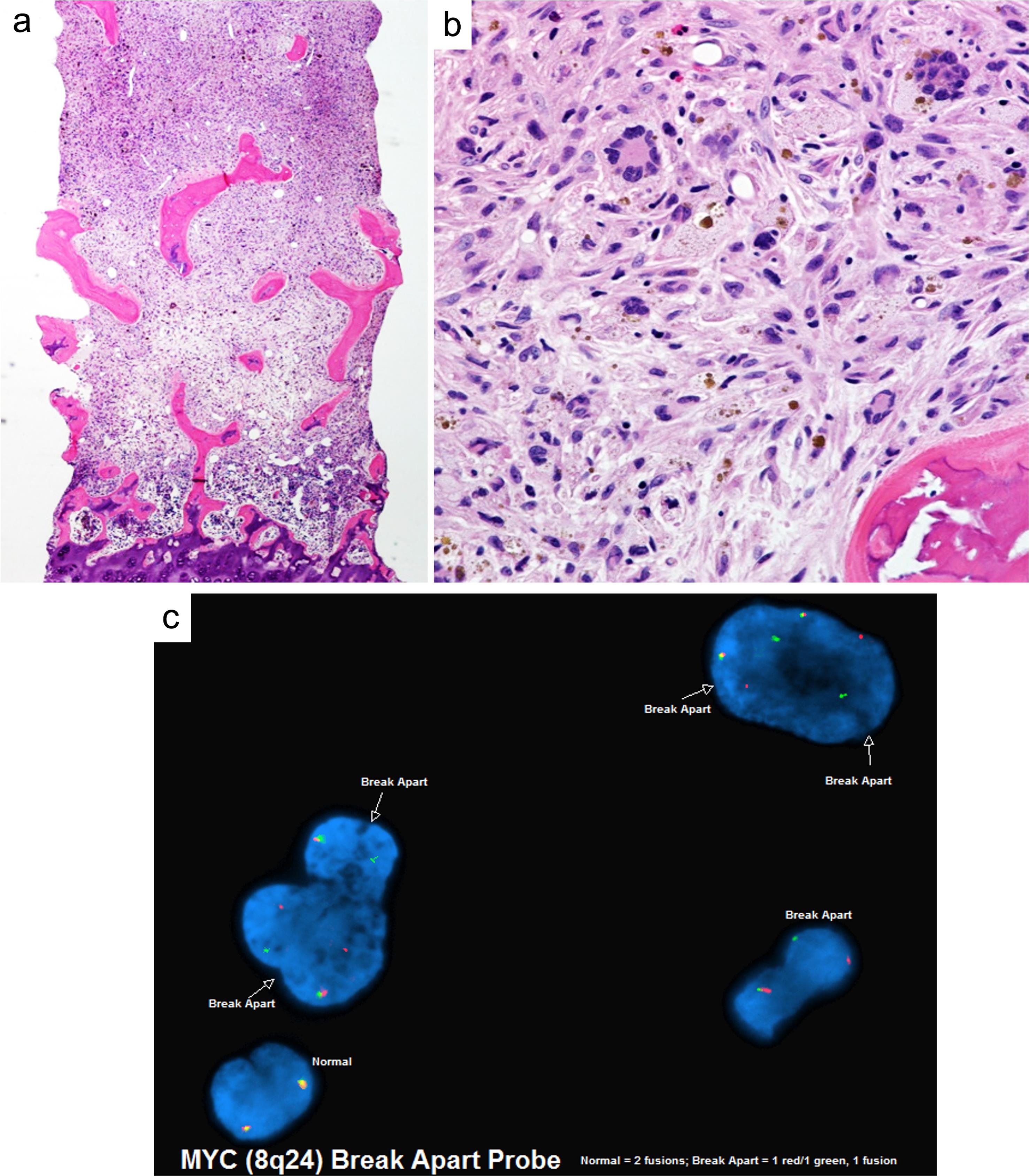 Example of histiocytic sarcoma secondary to T-lymphoblastic leukemia with MYC proto-oncogene (MYC) gene rearrangement.