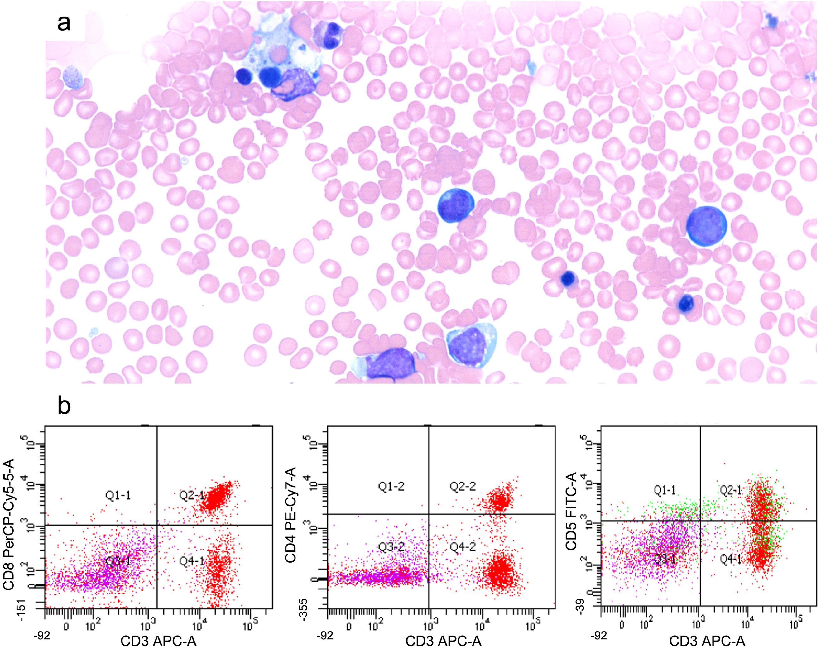 Example of aberrant T-cell population in familial hemophagocytic lymphohistiocytosis.