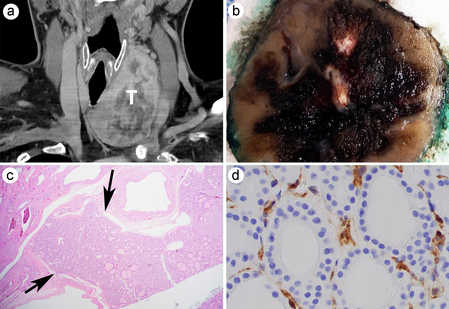 Follicular thyroid carcinoma (FTC) with loss of PTEN.