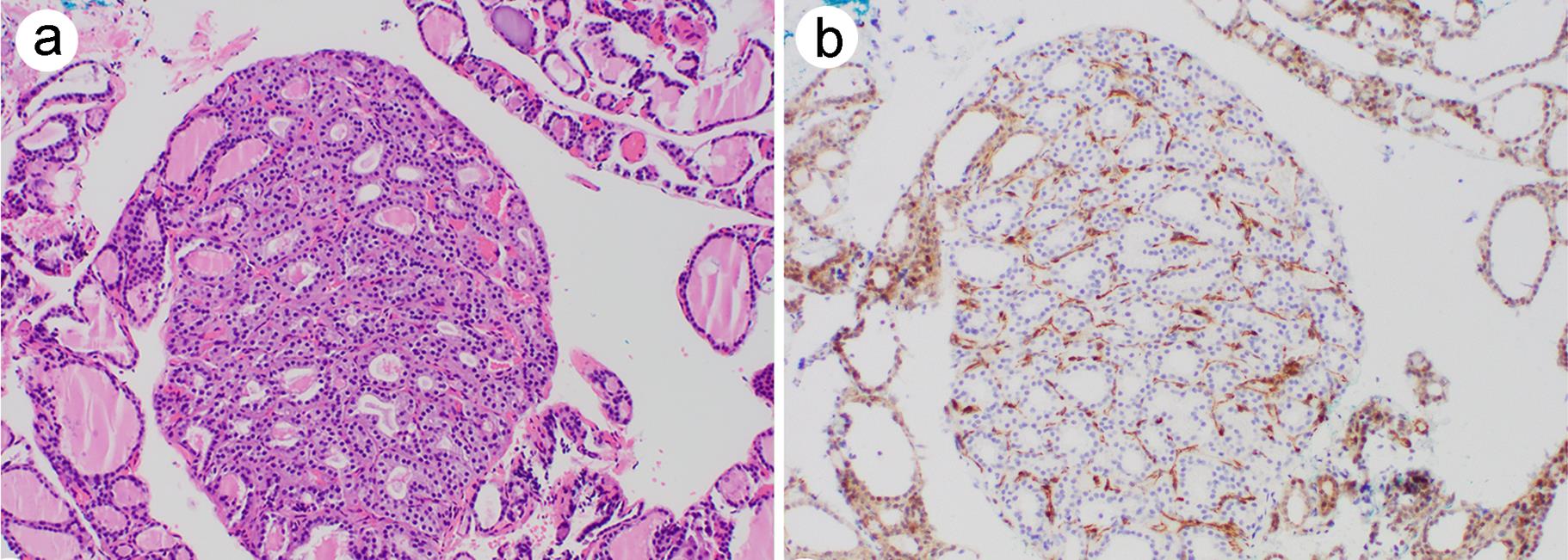 PTEN loss in the benign adenomatous nodule.